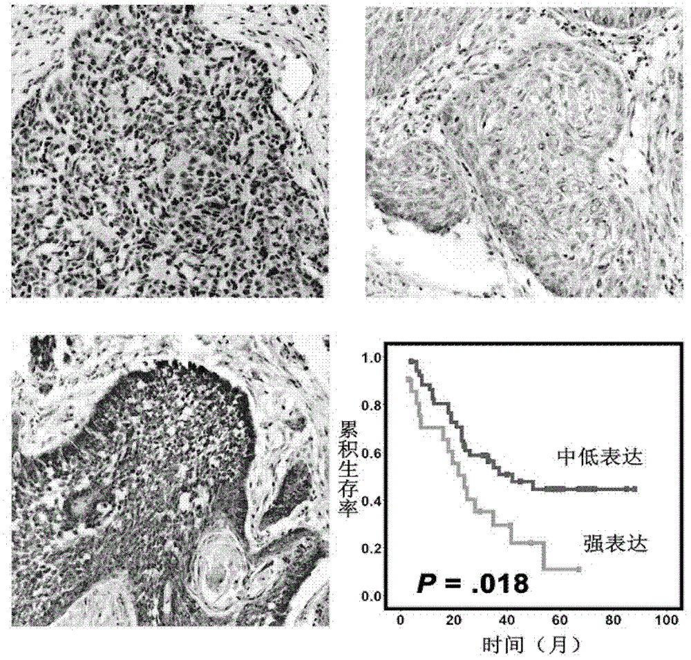 Application of quantitative detection of cpt1a gene or protein in prognosis of esophageal squamous cell carcinoma