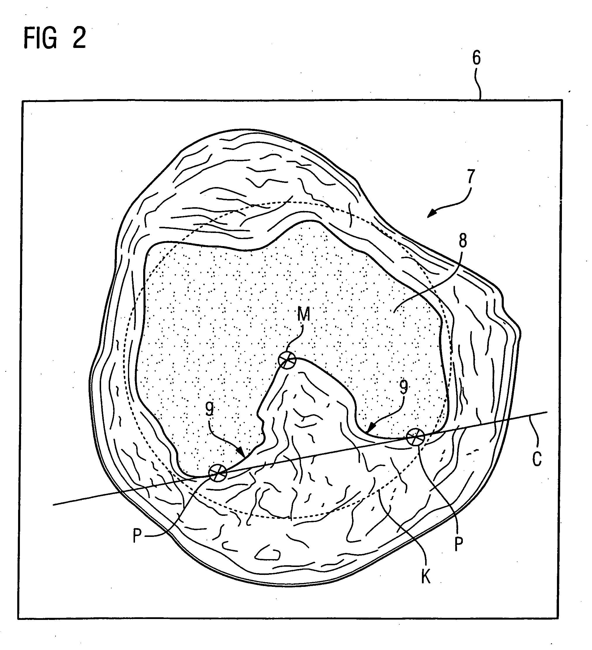 Mr method and apparatus for determining coronal and sagittal image planes from an image data set of a knee joint