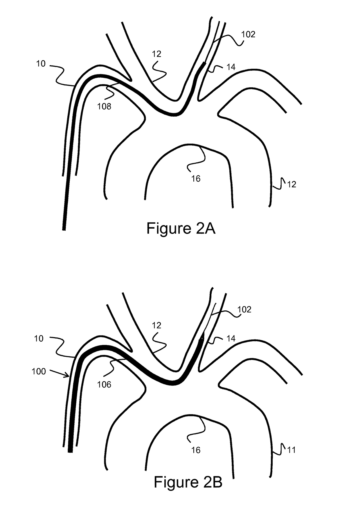 Methods and devices for embolic protection