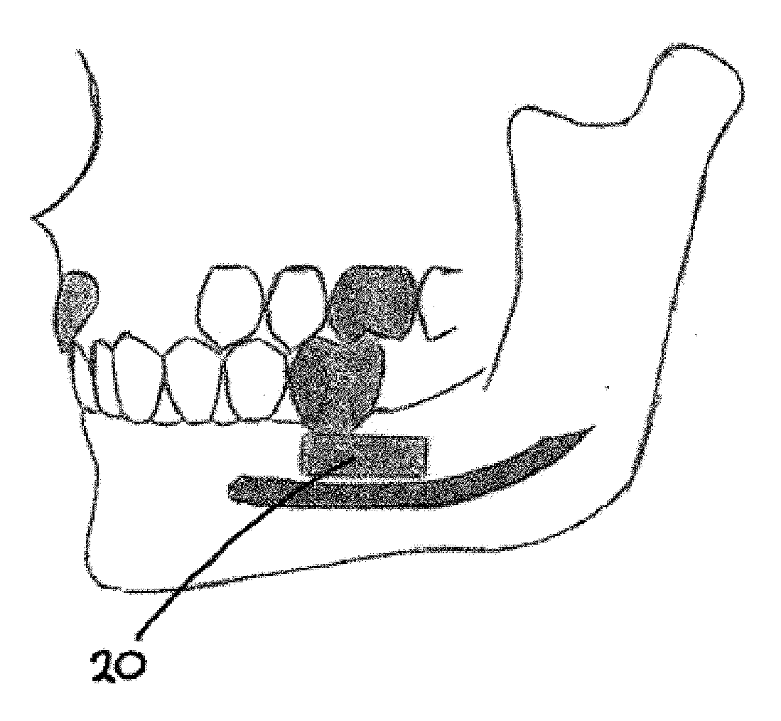 Dental implant