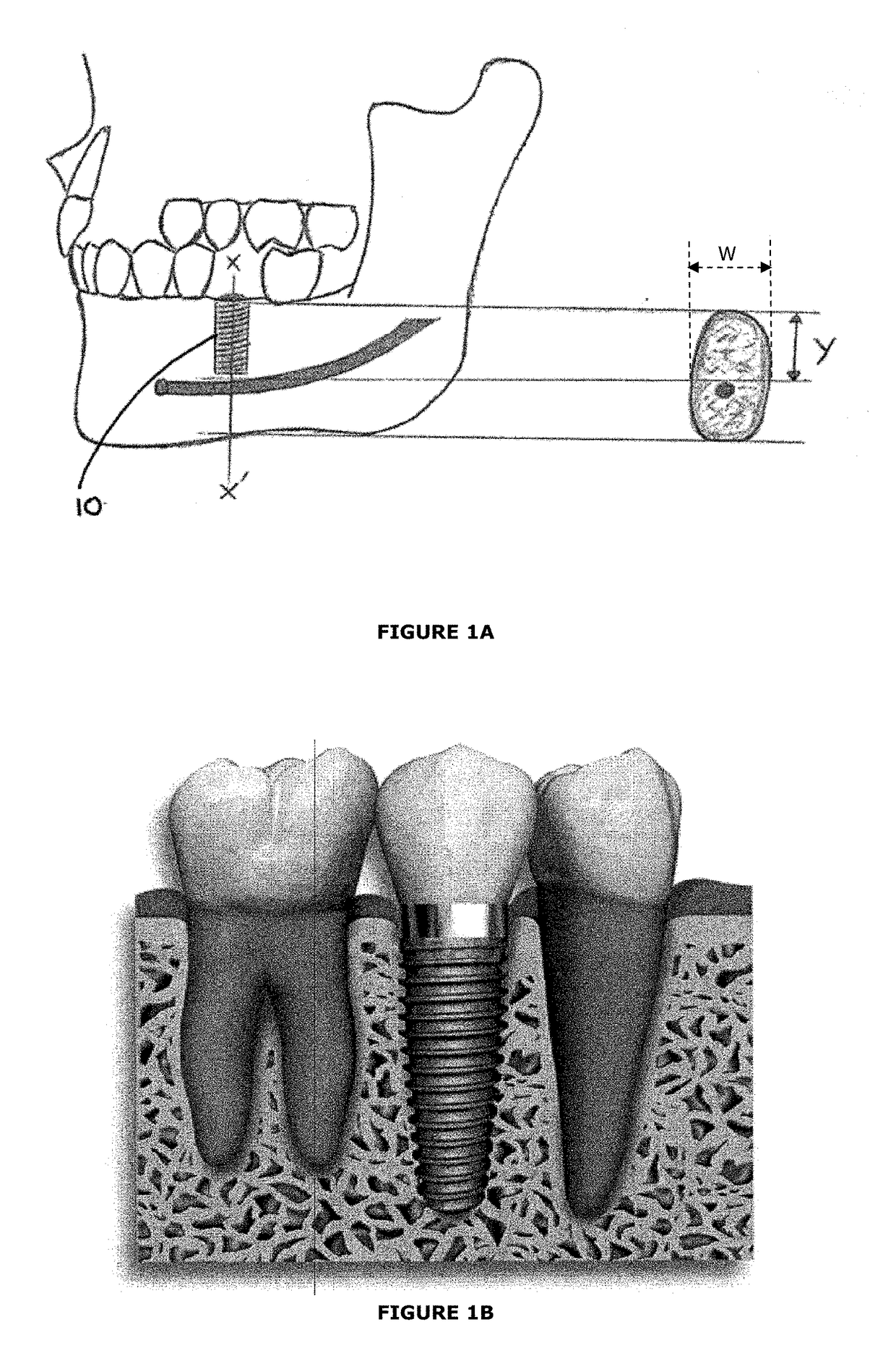 Dental implant