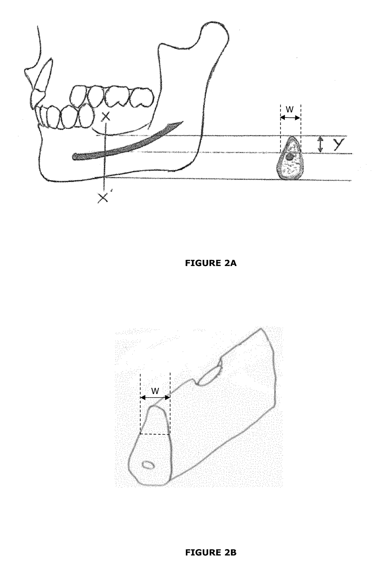 Dental implant