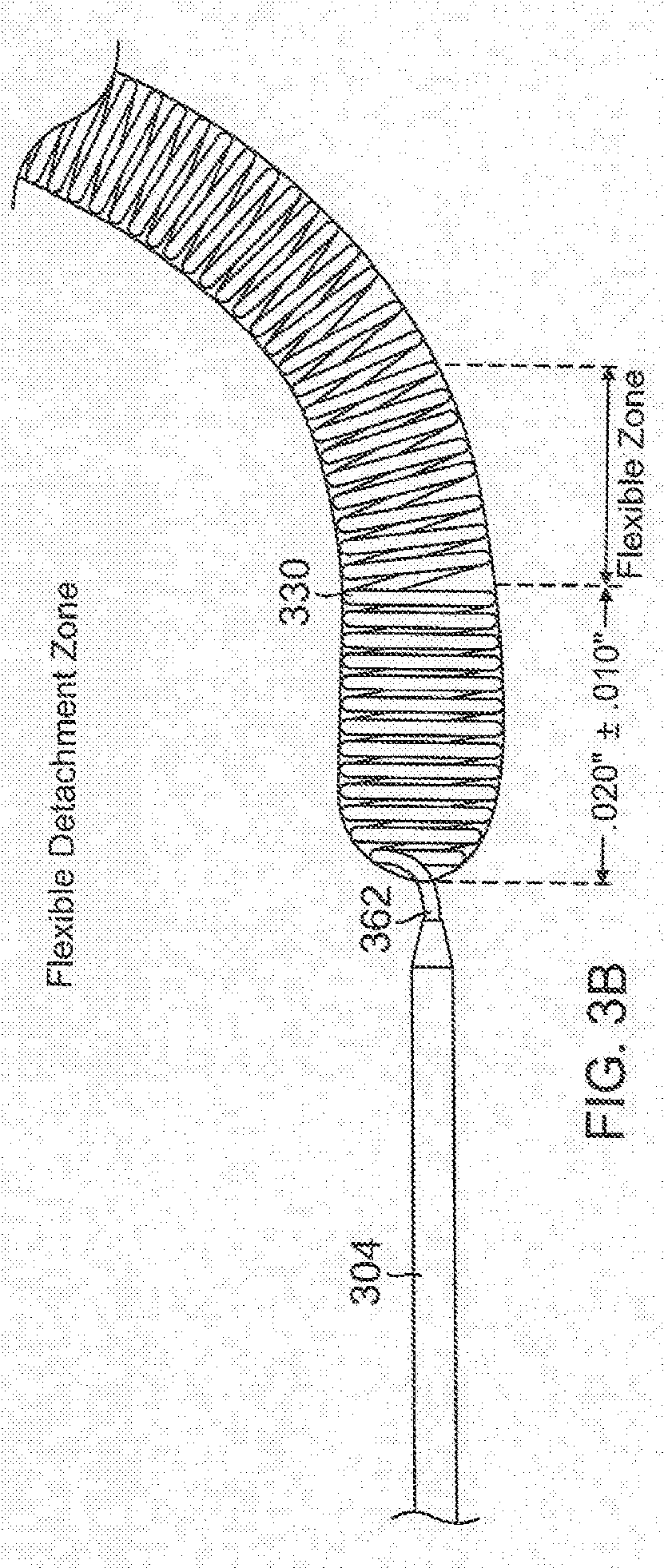 Vascular Implant System and Processes with Flexible Detachment Zones