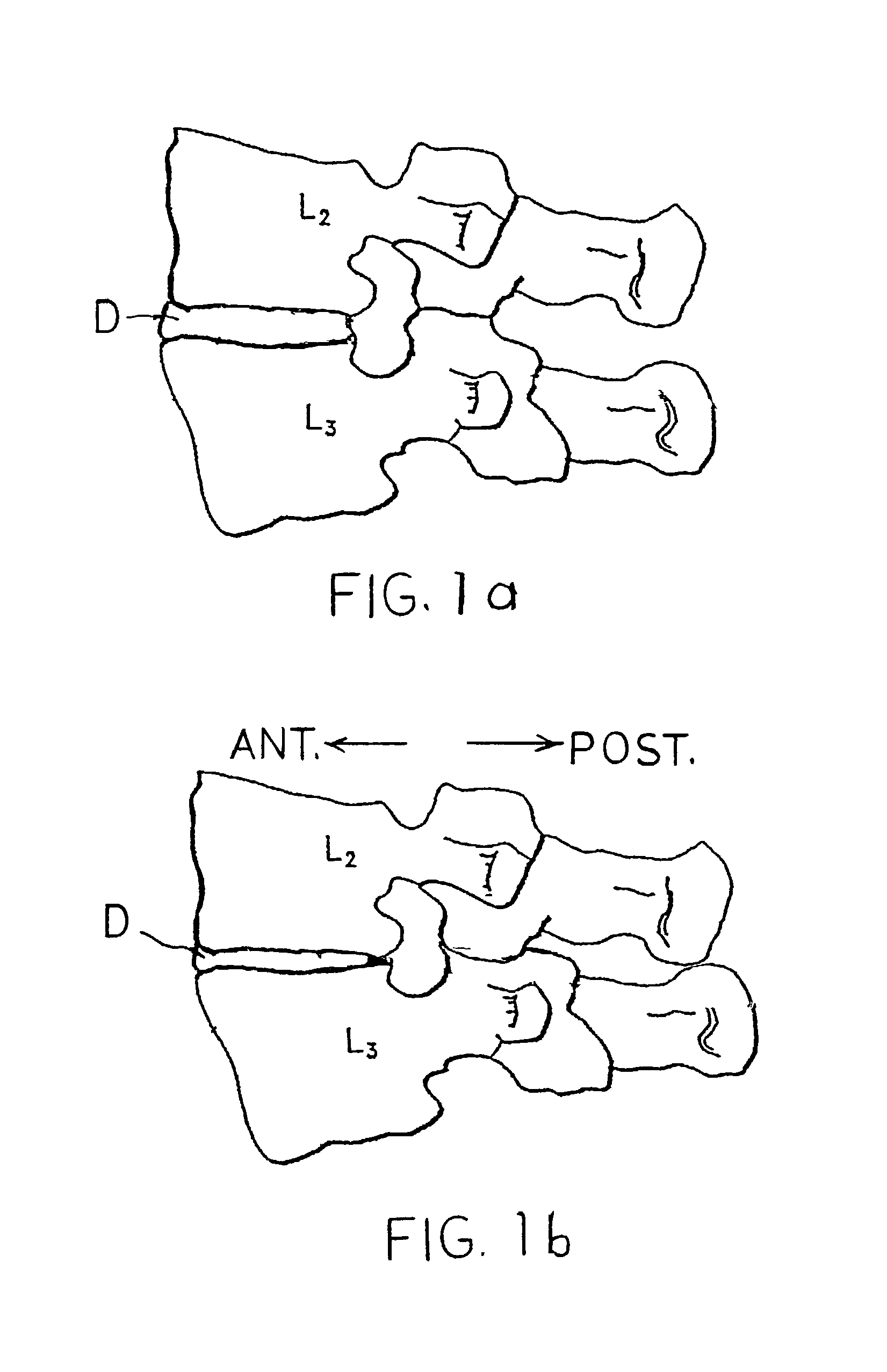 Devices and methods for the restoration of a spinal disc
