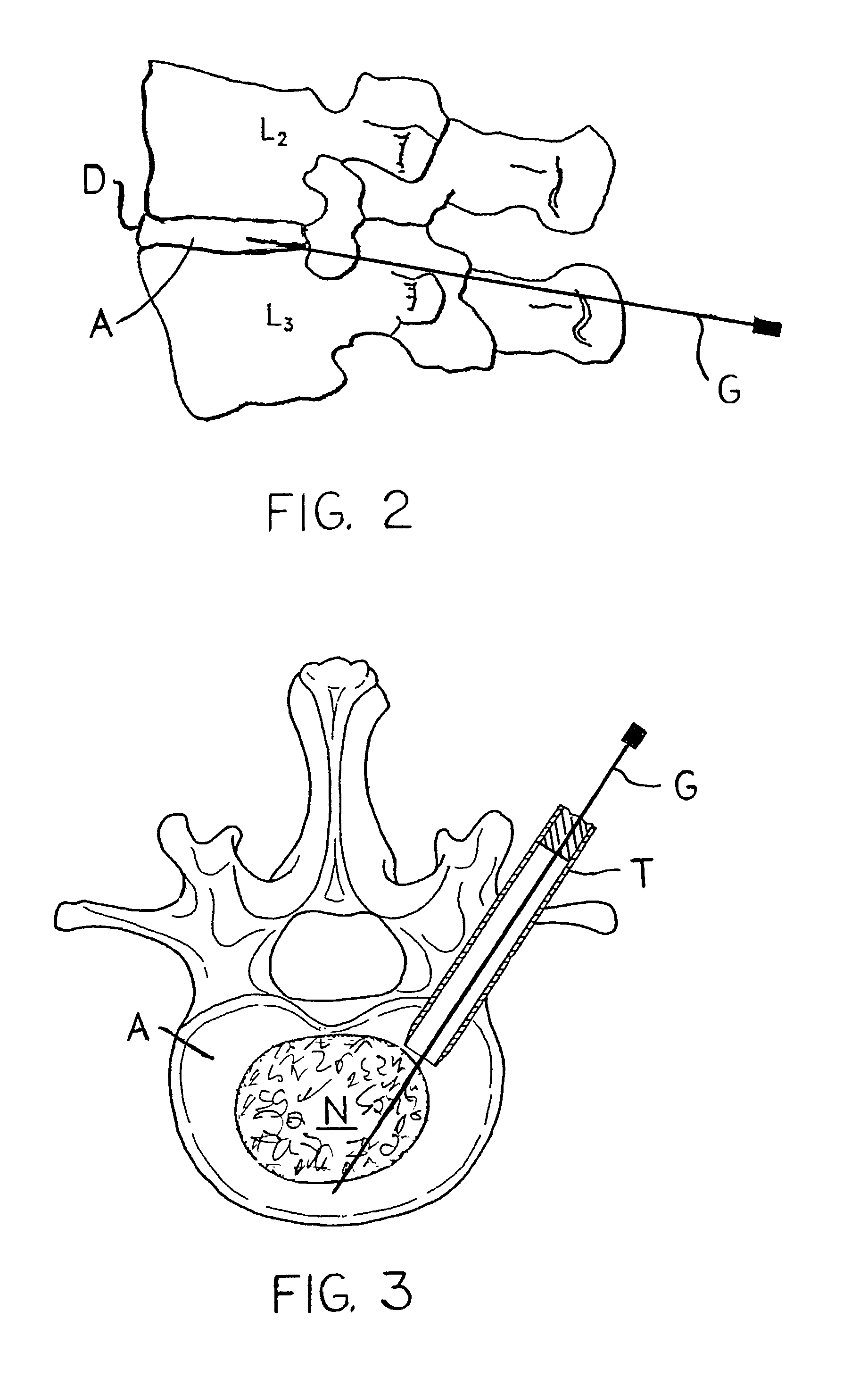 Devices and methods for the restoration of a spinal disc