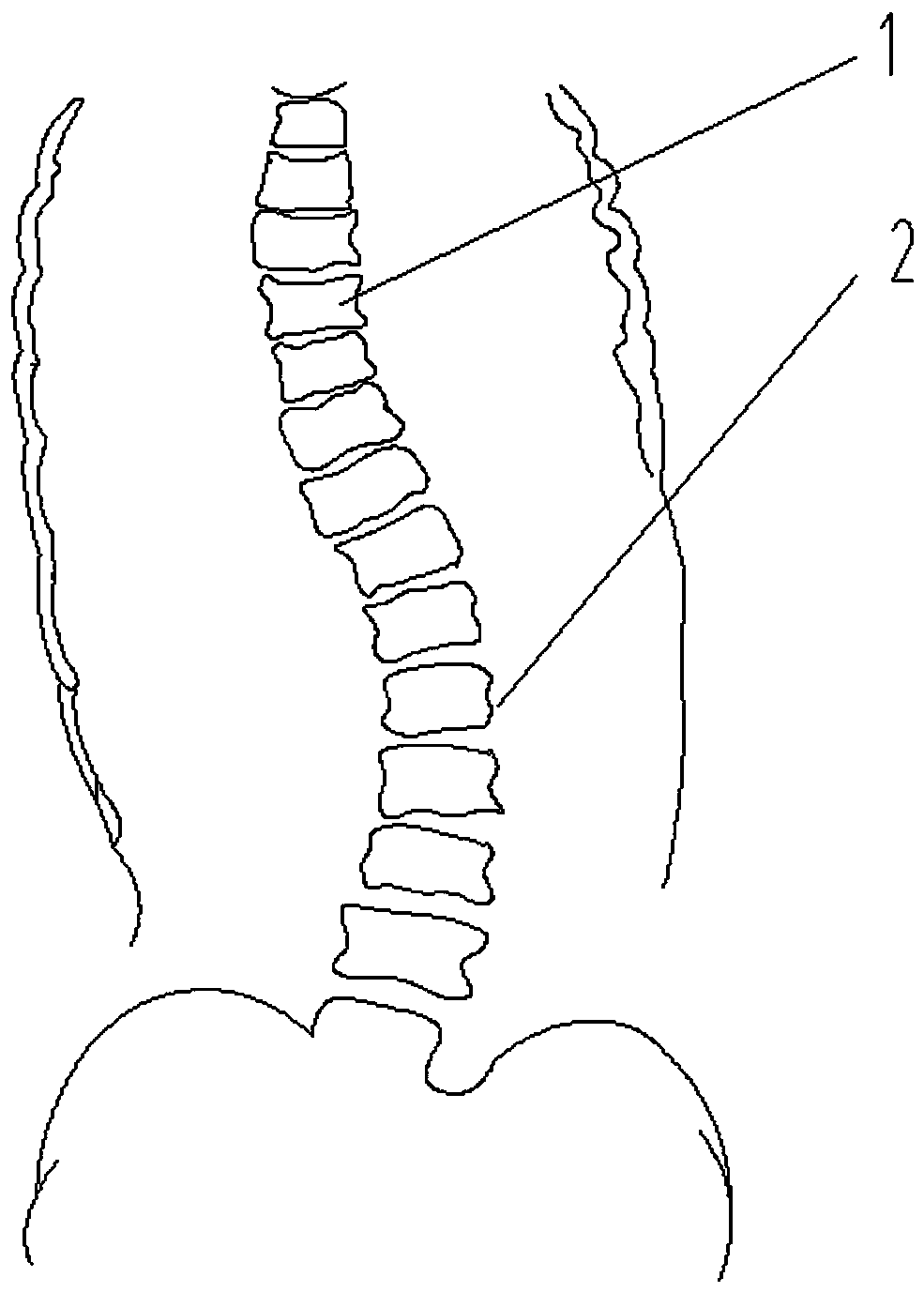 Correcting device for scoliosis