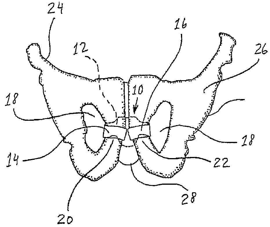 Implantable sling for the treatment of incontinence and method of using the same