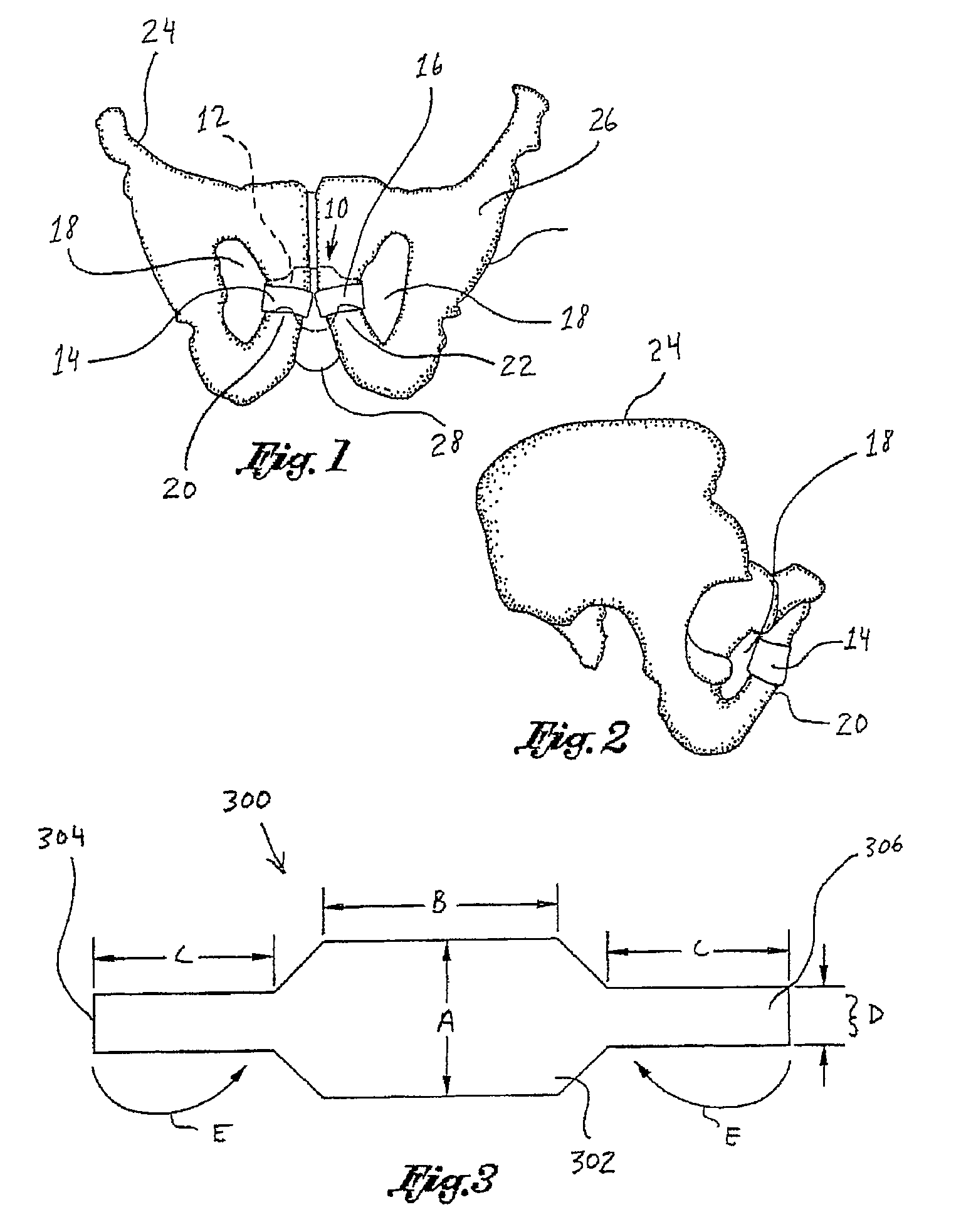 Implantable sling for the treatment of incontinence and method of using the same