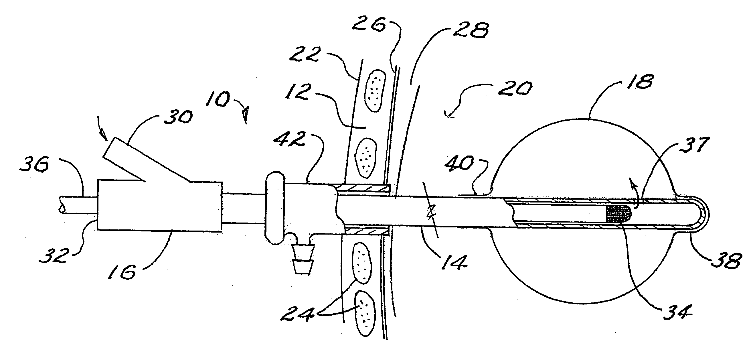 Brachytherapy apparatus and method for use with minimally invasive surgeries of the lung