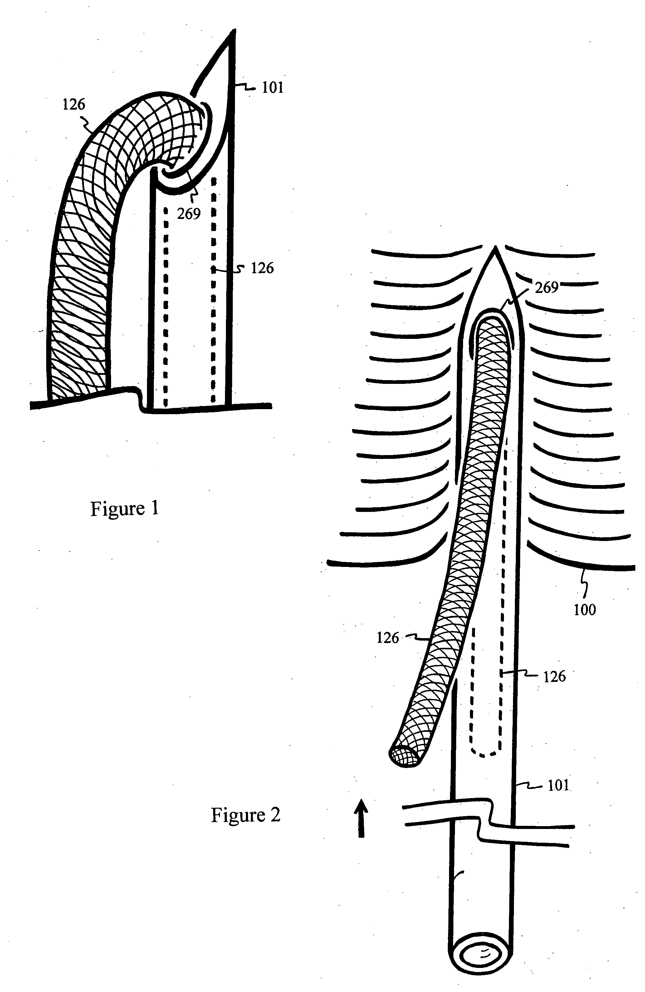 U-shaped disc shunt and delivery device