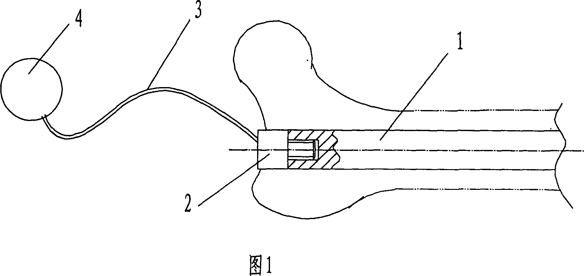Inner nail of anal filaments marrow, and embedding, extracting method