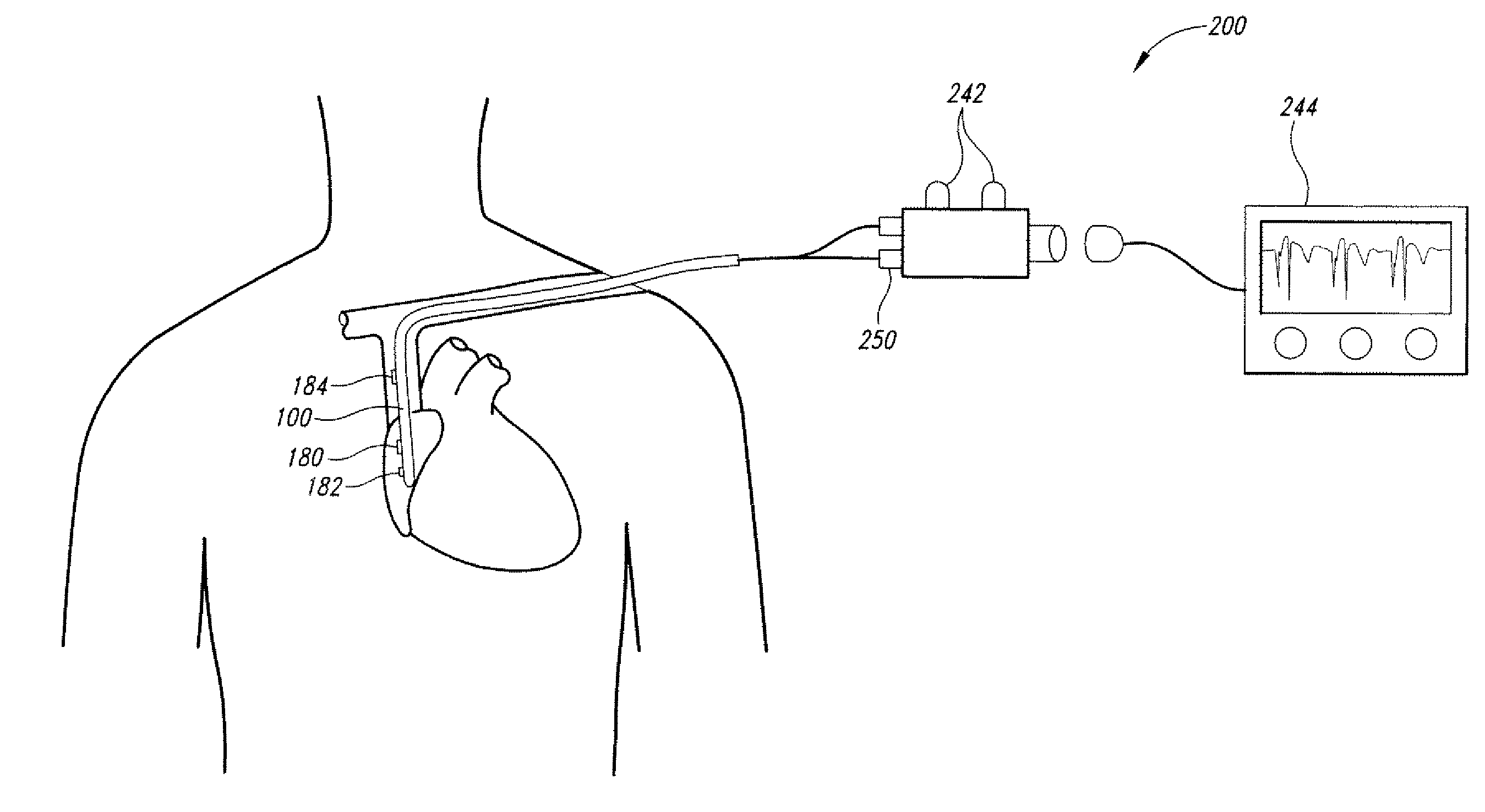 Method of locating the tip of a central venous catheter