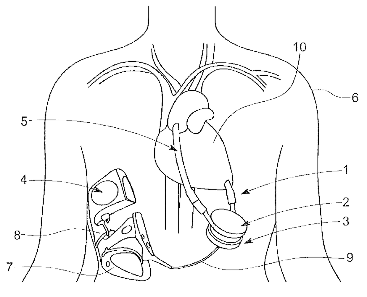 Low cost ventricular device and system thereof