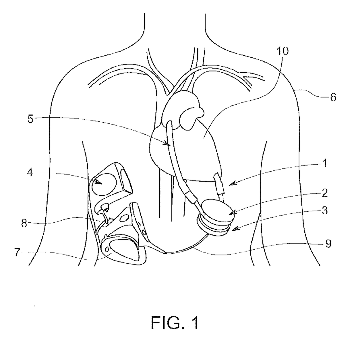 Low cost ventricular device and system thereof