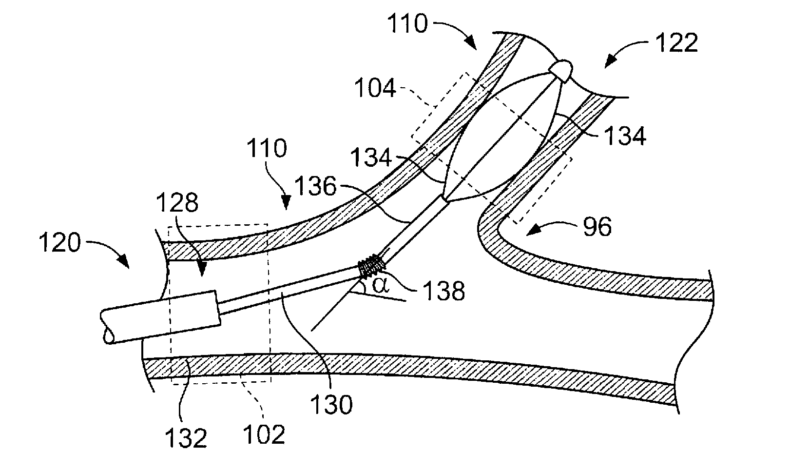 Medical device with procedure improvement features