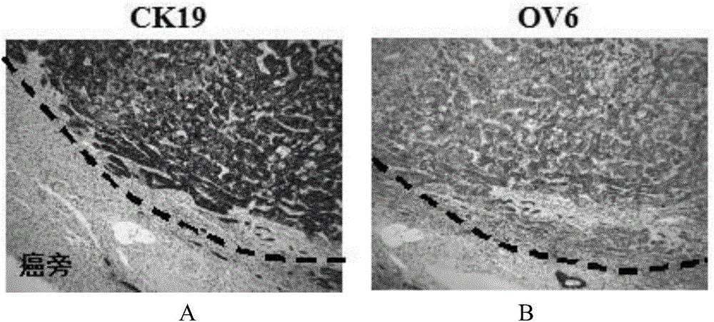 Application of ck19 combined with ov6 in preparation of liver cancer molecular typing kit and individualized treatment of liver cancer