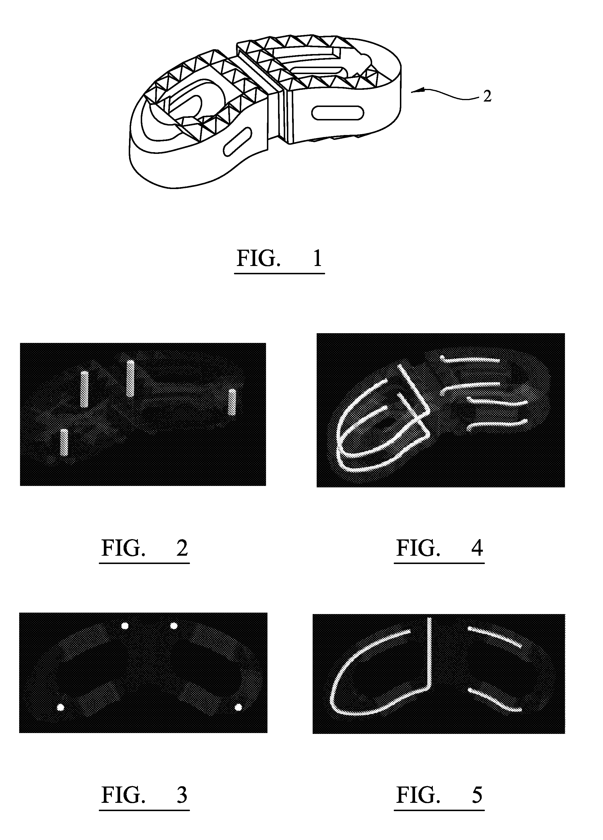 Method for Manufacturing a Medical Implant With a Radiopaque Marker