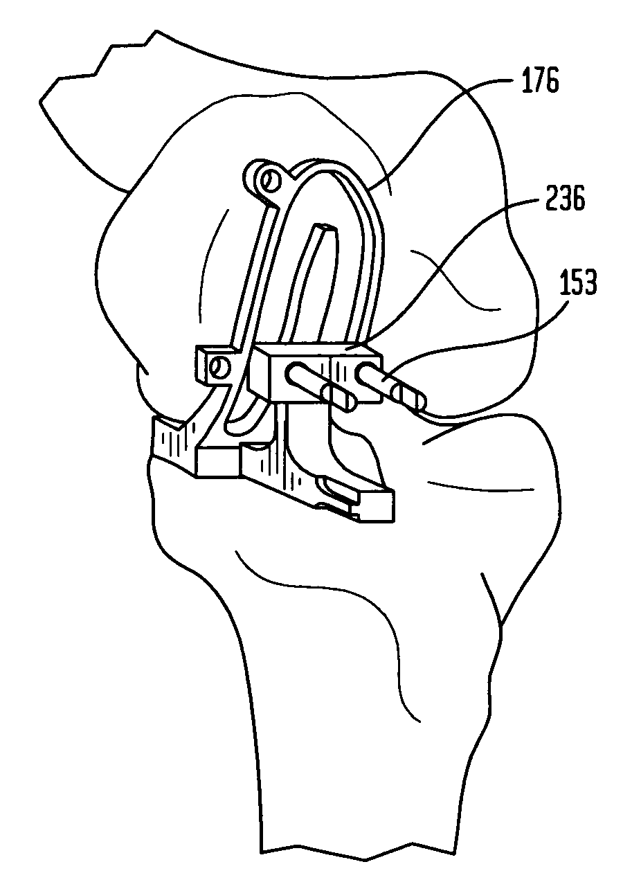 Unicondylar knee implants and insertion methods therefor