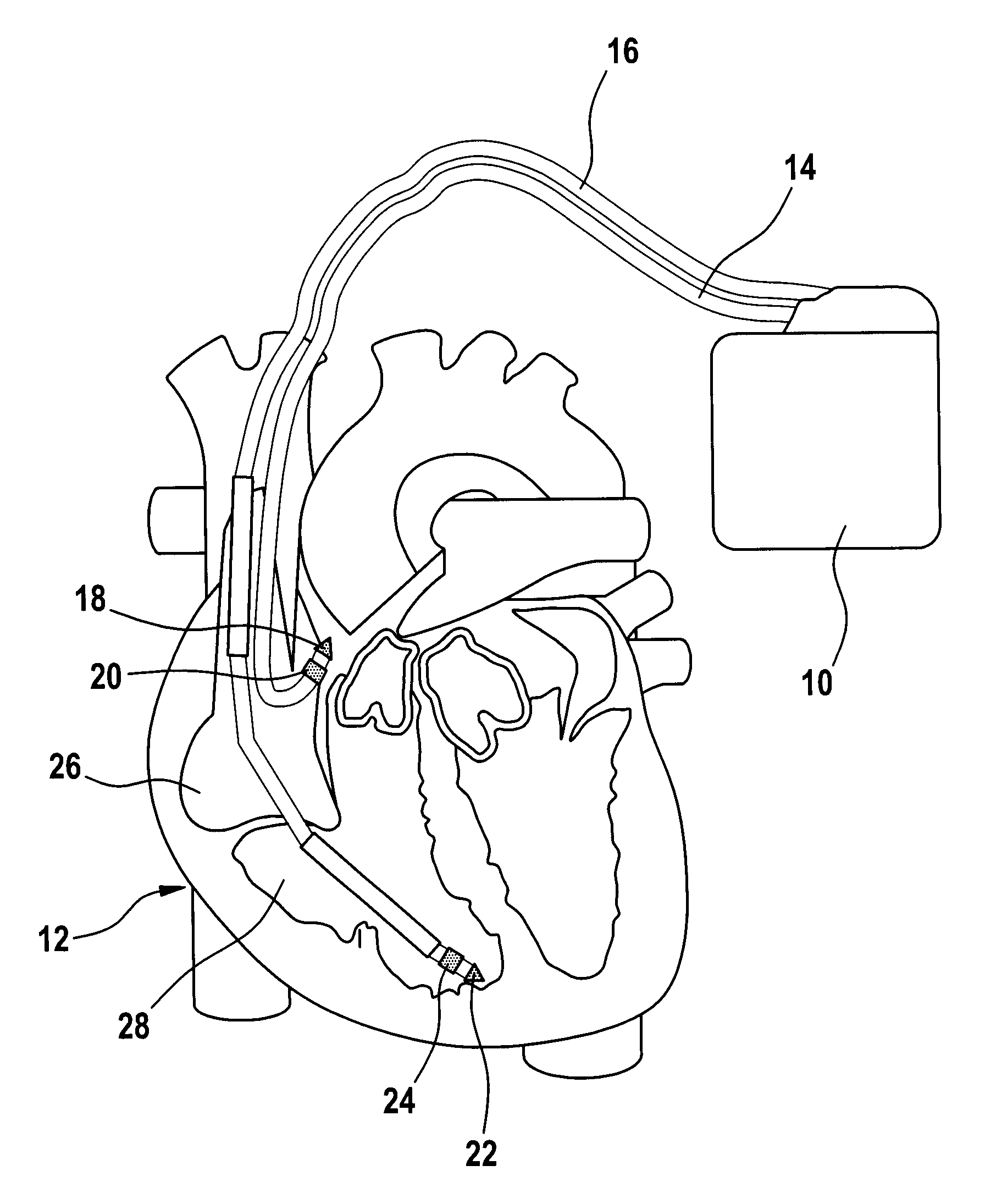 Heart Stimulator