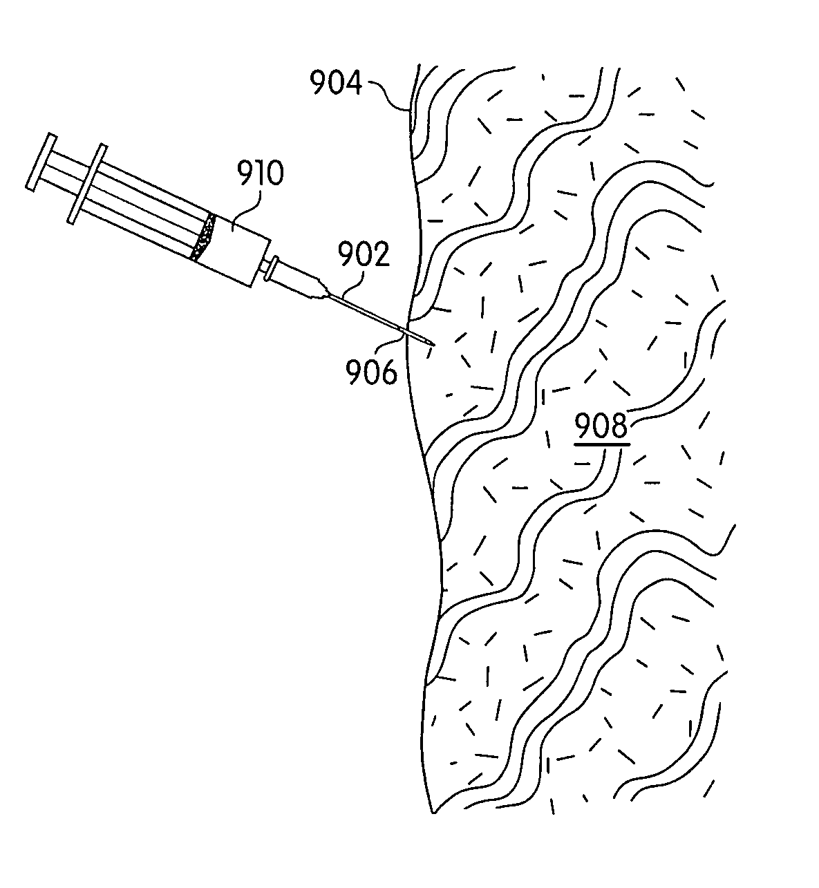 Injectable sustained release delivery devices