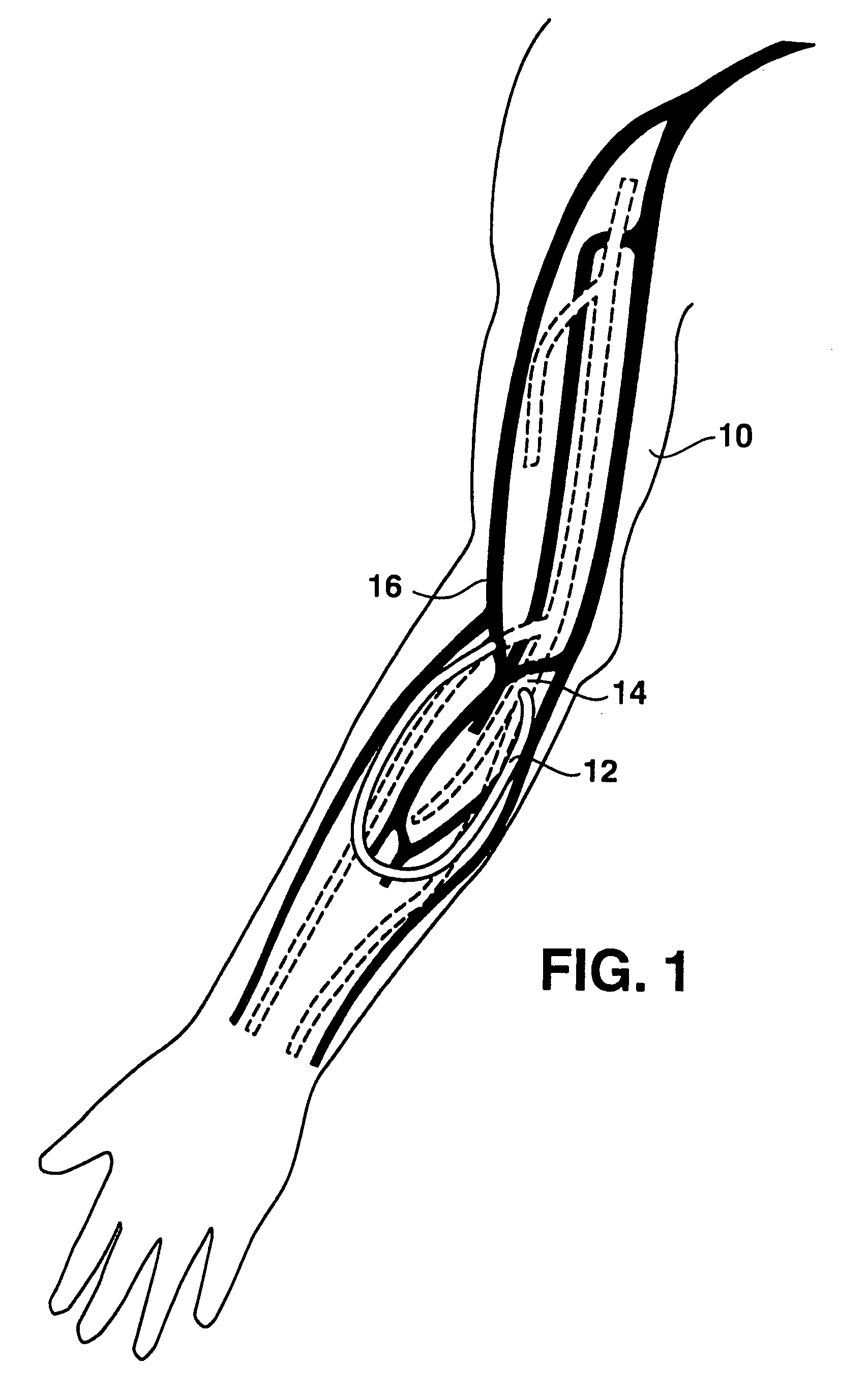 Arteriovenous access valve system and process