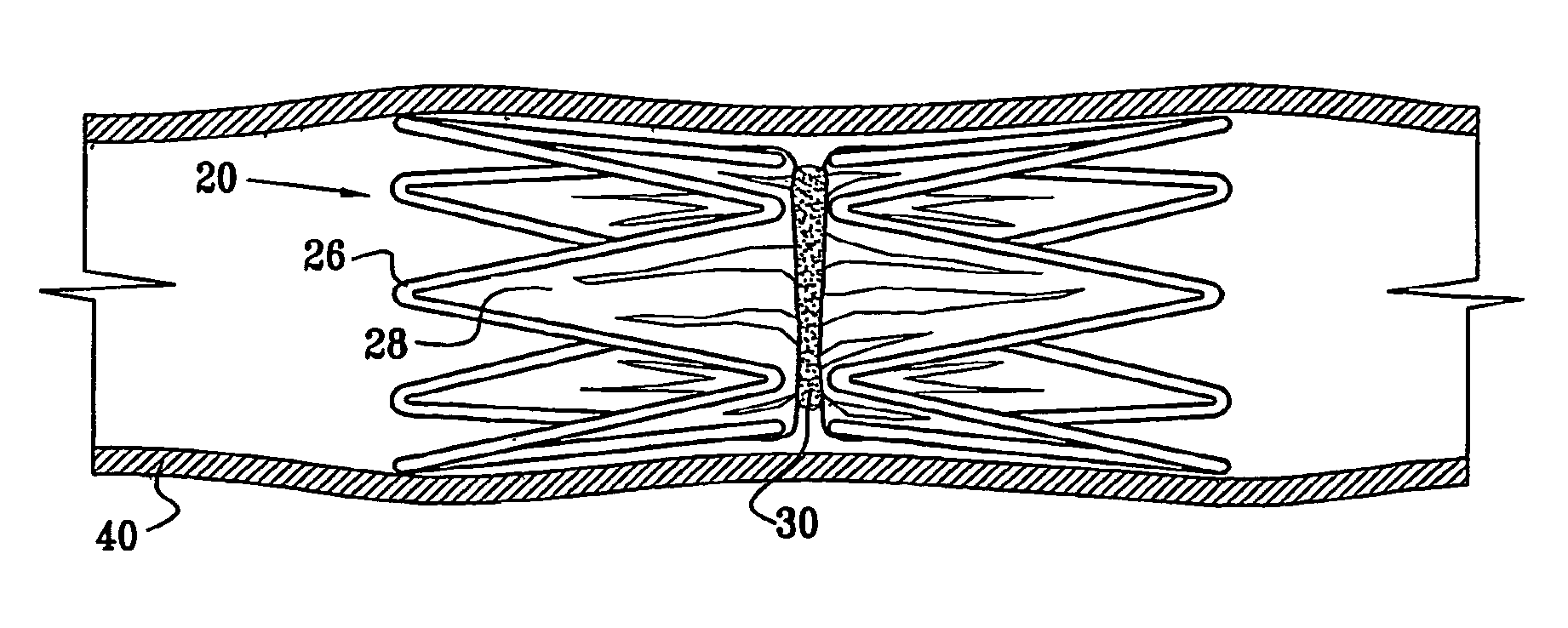 Vascular implant