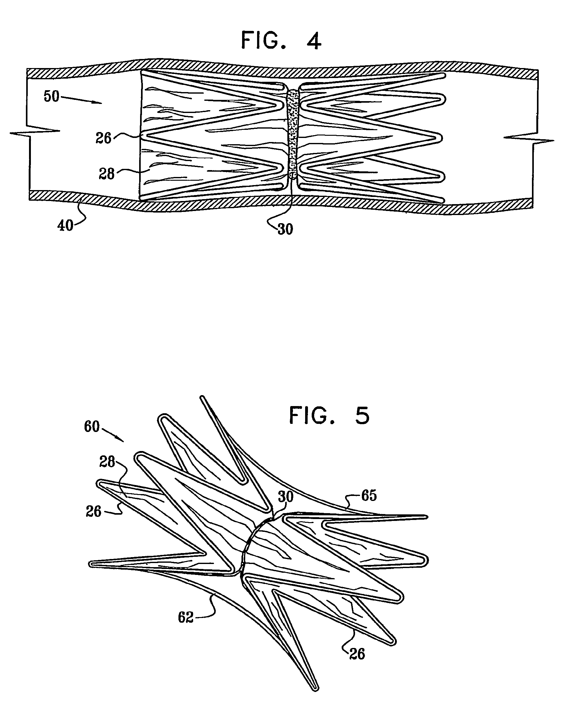 Vascular implant