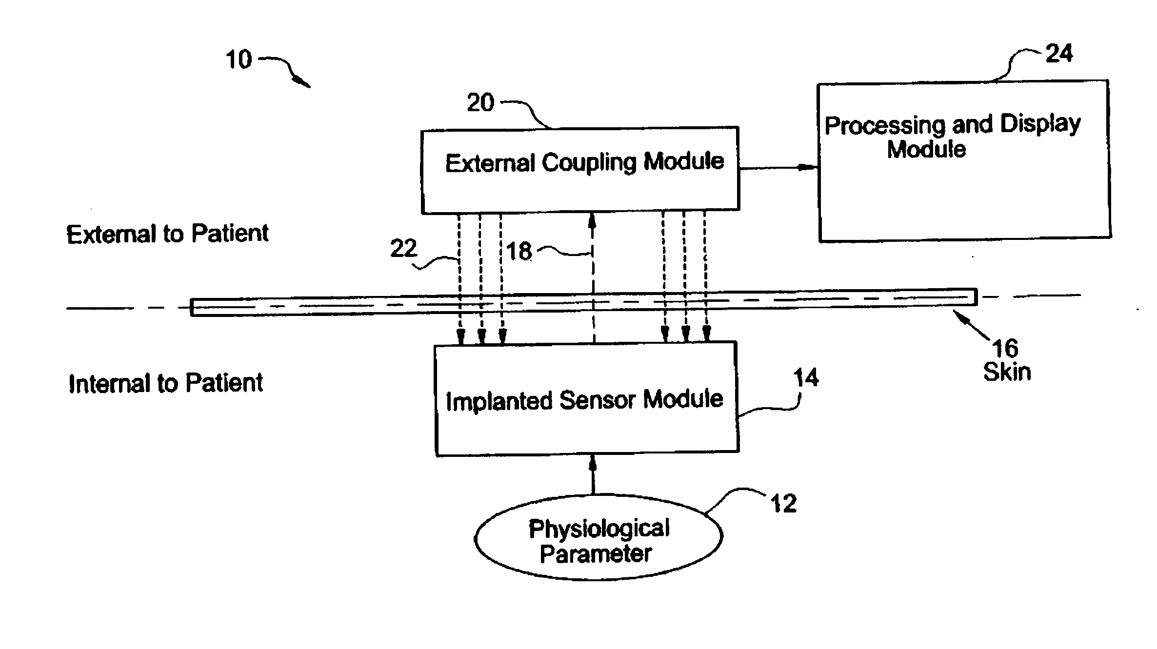 System for transcutaneous monitoring of intracranial pressure