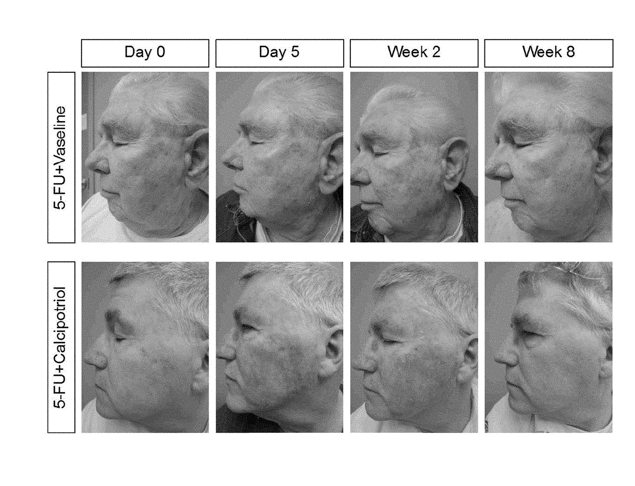 Compositions and methods for treatment of pre-cancerous skin lesions