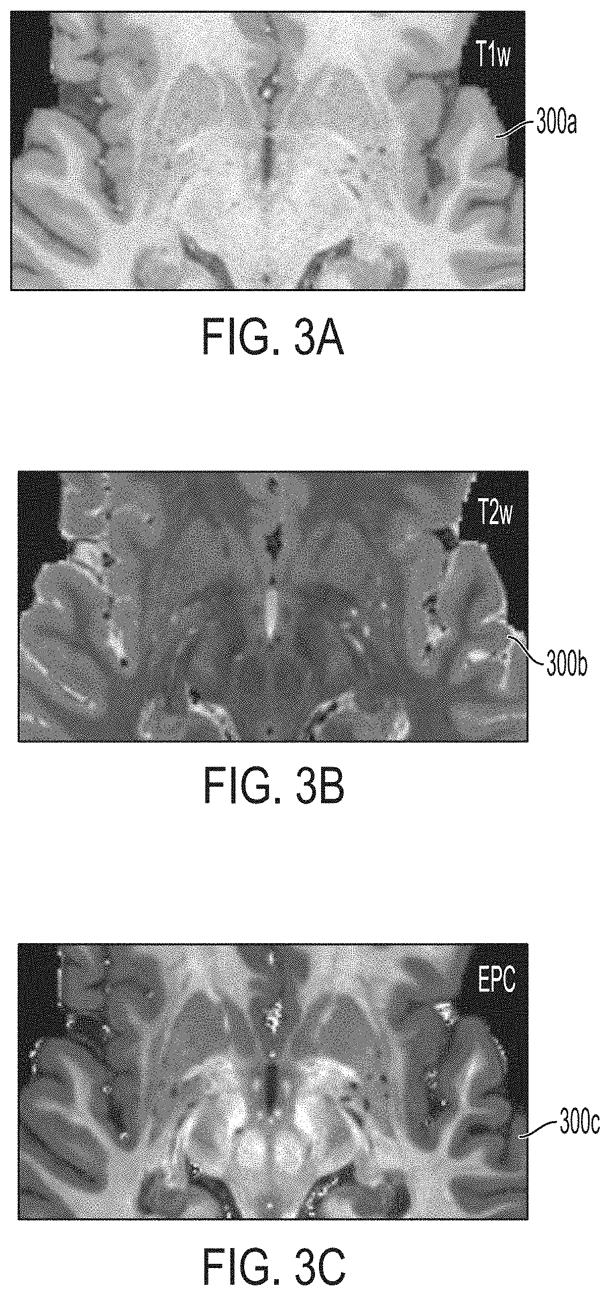 Mapping brain perivascular spaces