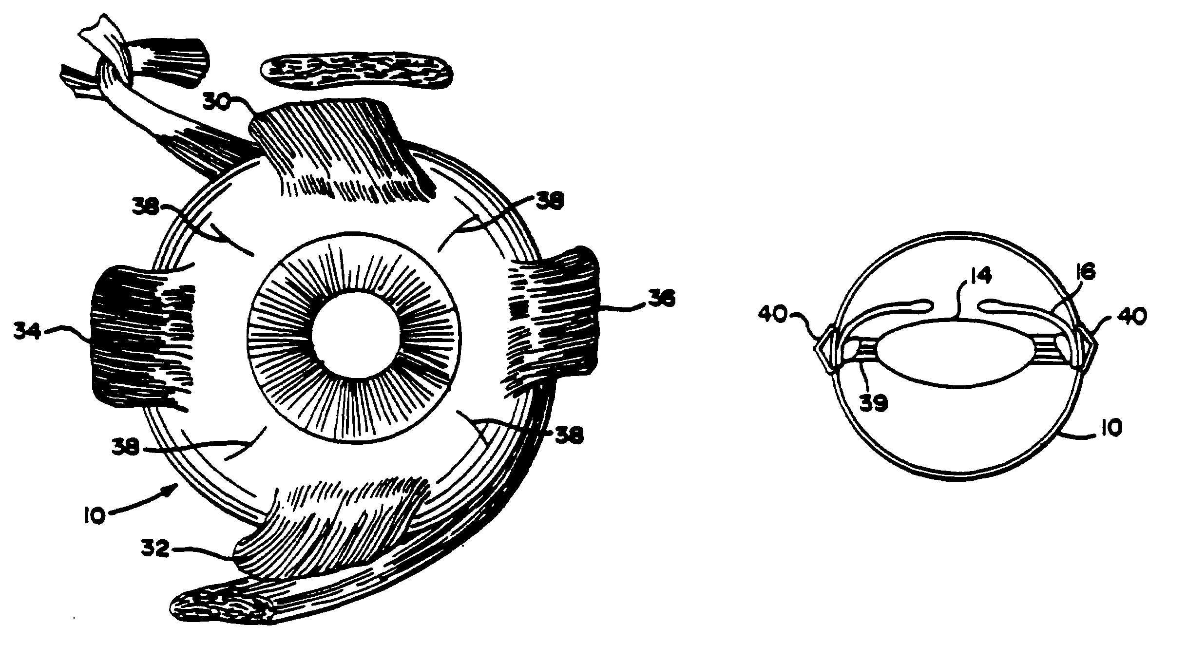Scleral clip and procedures for using same