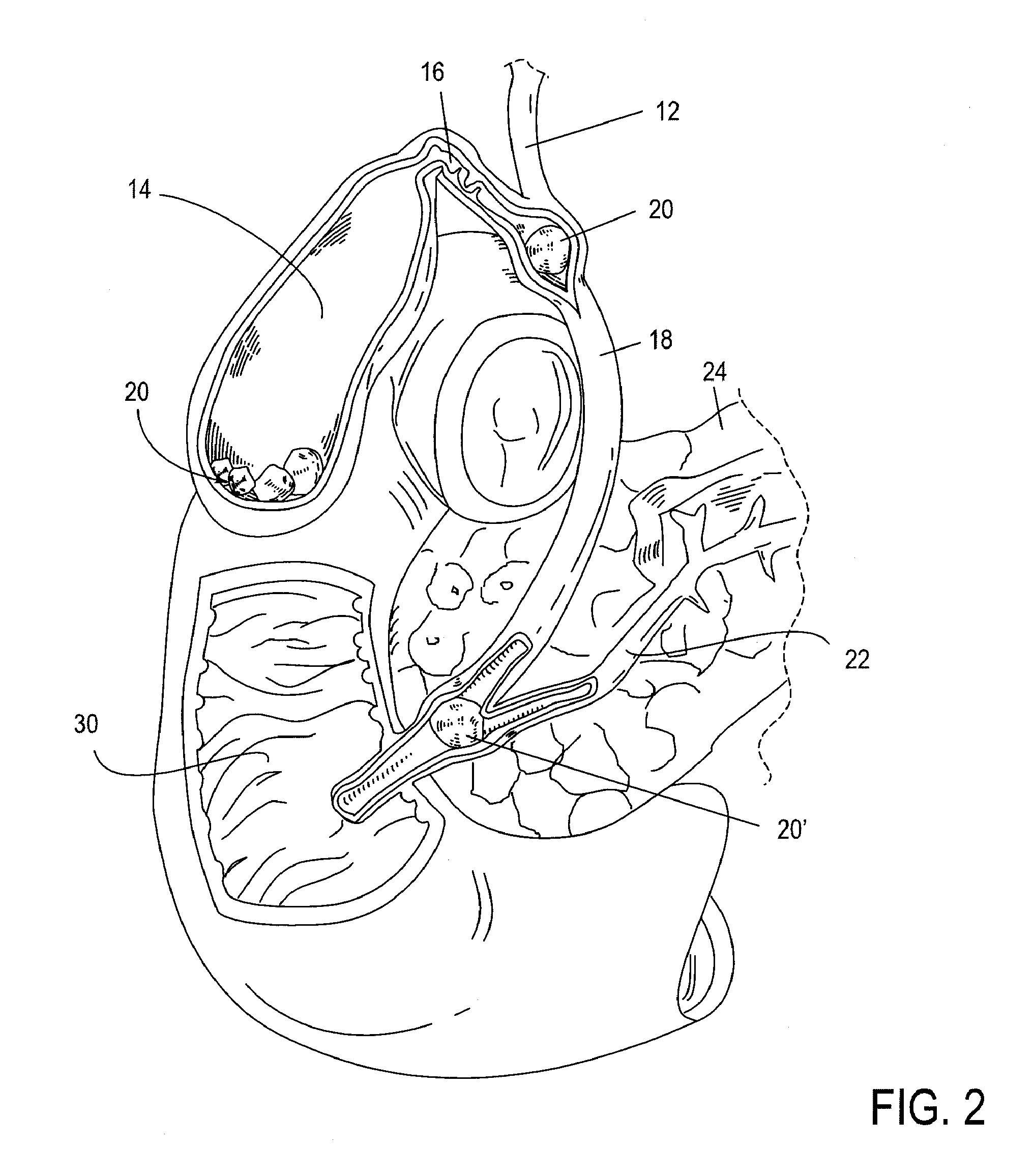 Applicator for endoscopic treatment of biliary disease