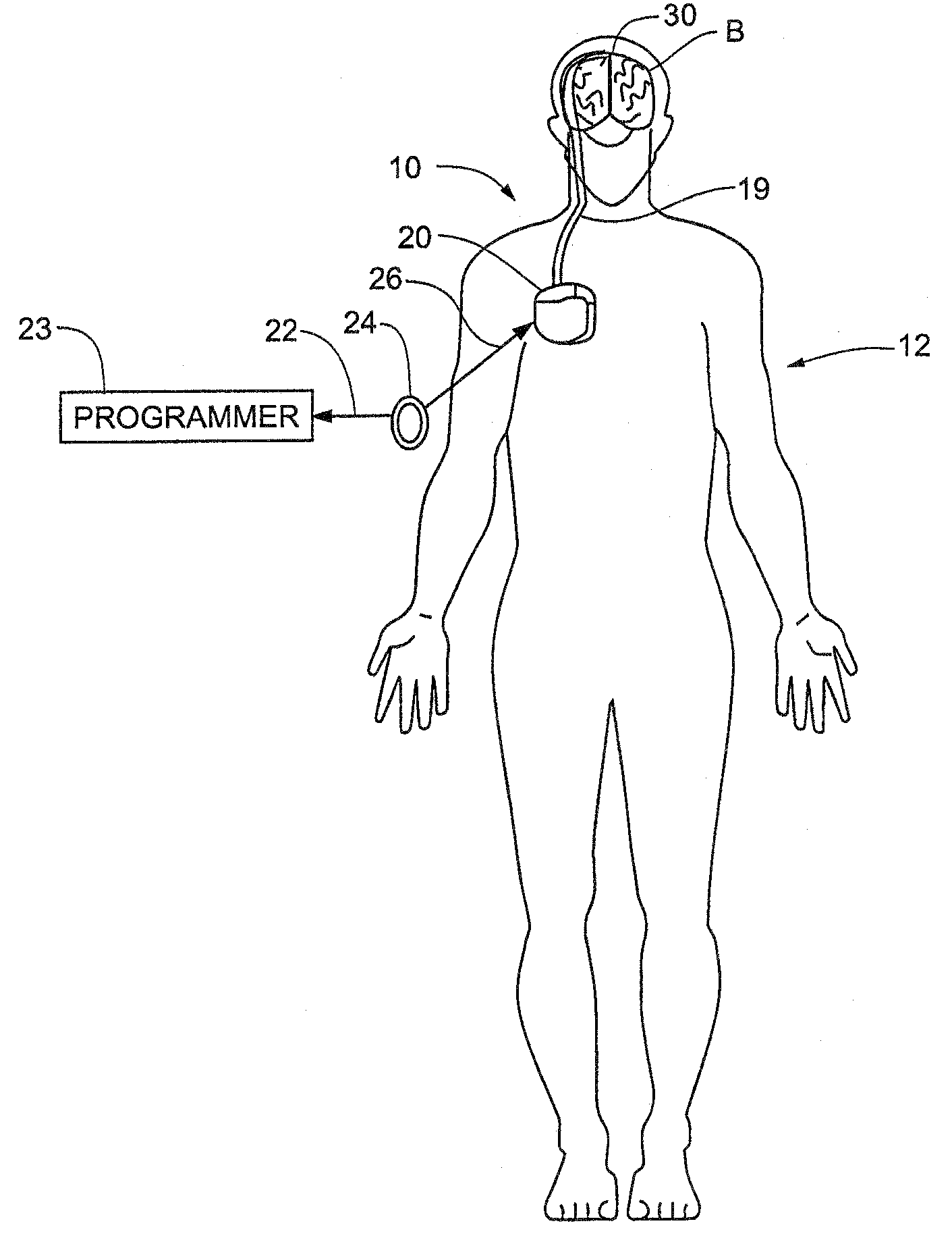 Method and Apparatus for the Treatment of Movement Disorders