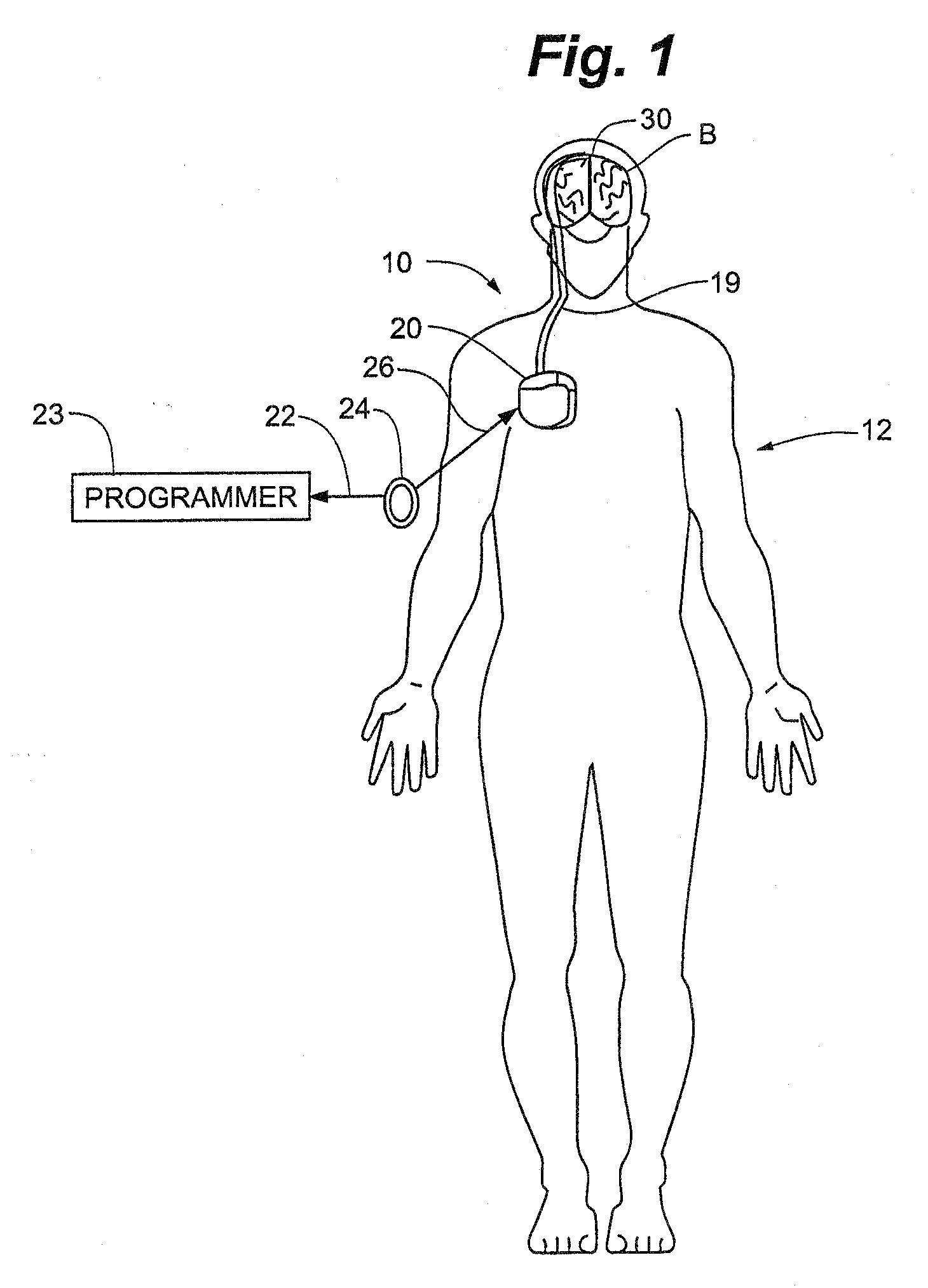 Method and Apparatus for the Treatment of Movement Disorders