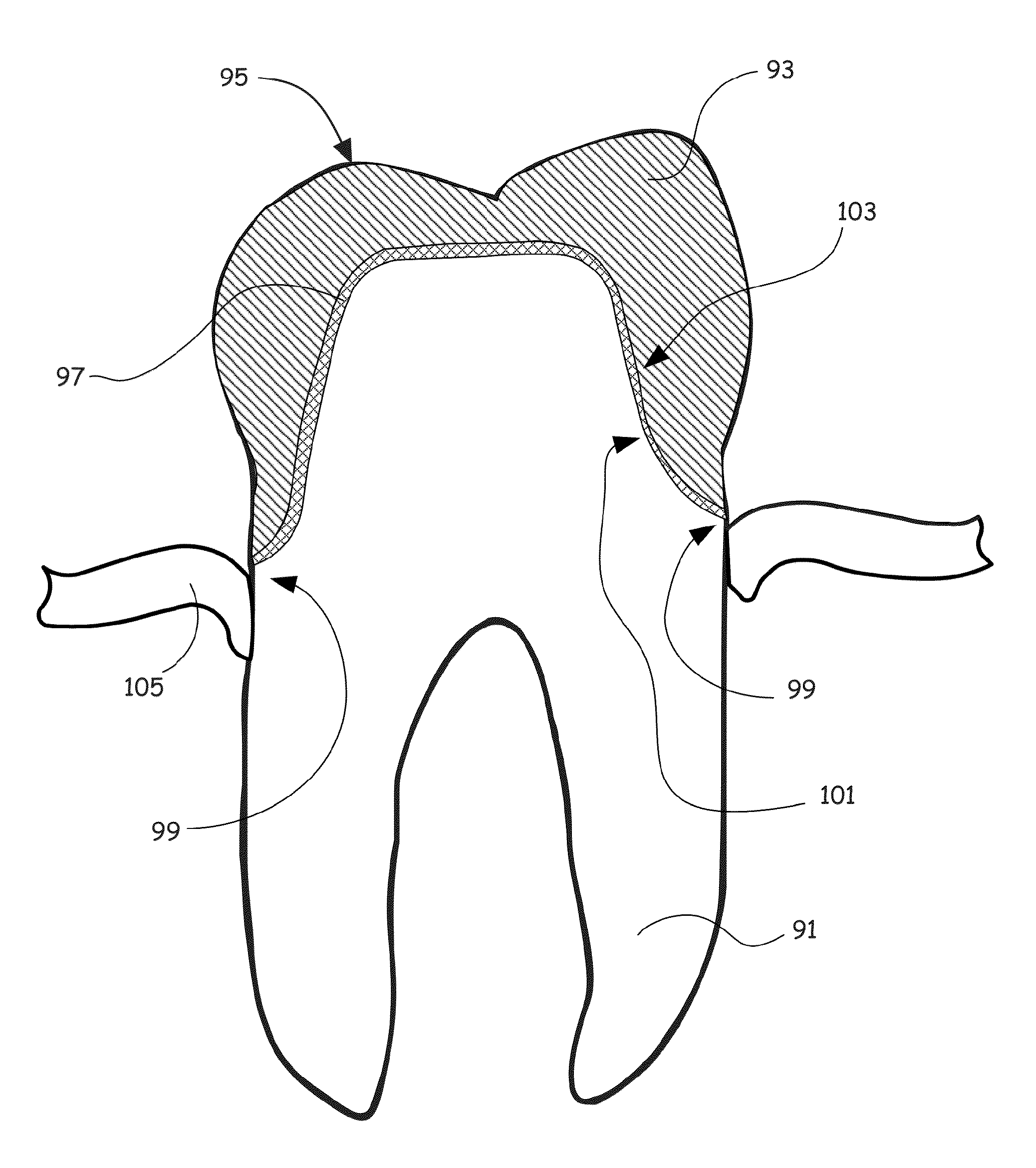 Dental Implant Assembly, Implant, and Prosthesis to Replace a Nonfunctional Natural Tooth and Related Methods