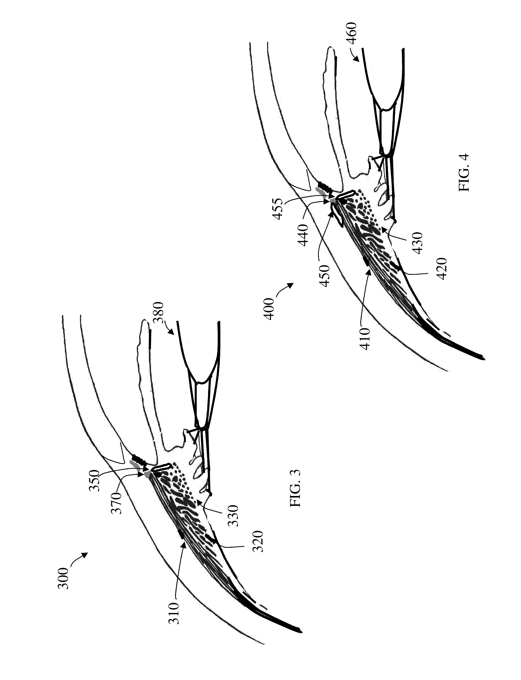 Presbyopia correcting wireless optical system