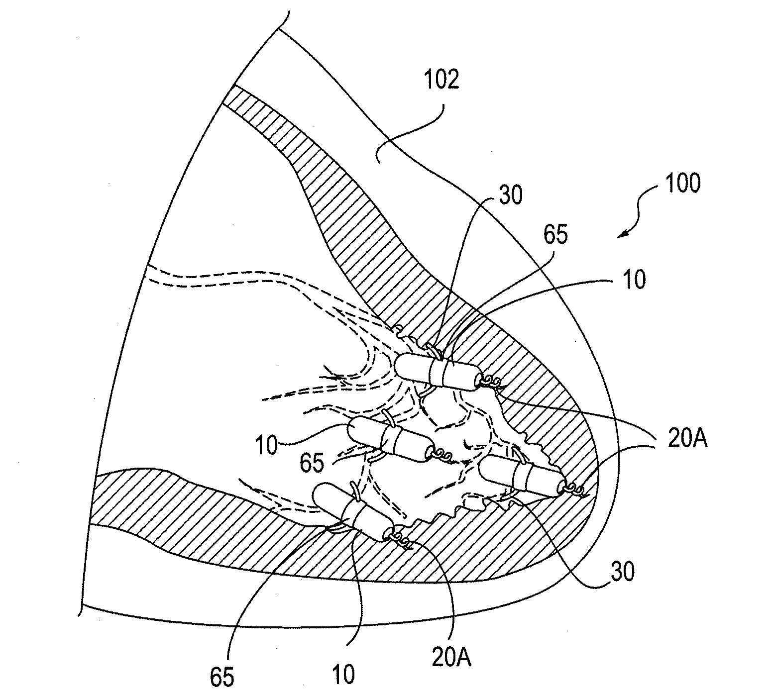 Leadless Cardiac Pacemaker with Secondary Fixation Capability