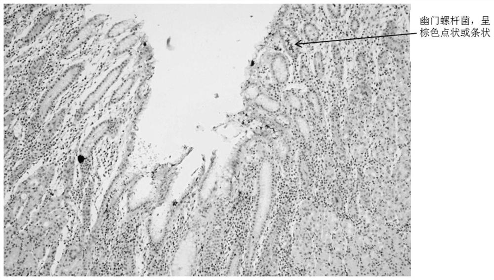 Helicobacter pylori staining kit and application