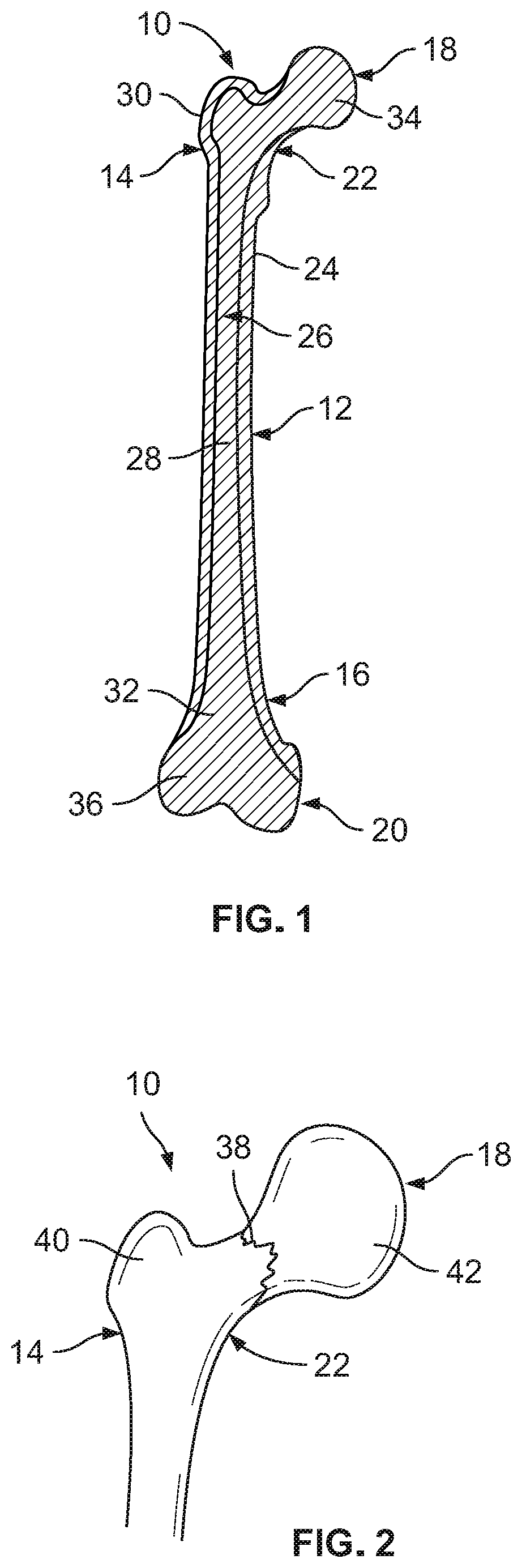 Locking System For Femoral Neck Fracture Fixation
