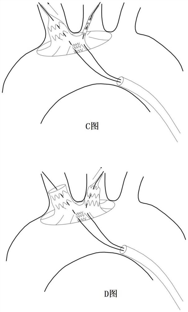 Covered stent for reconstructing aortic arch and branches thereof