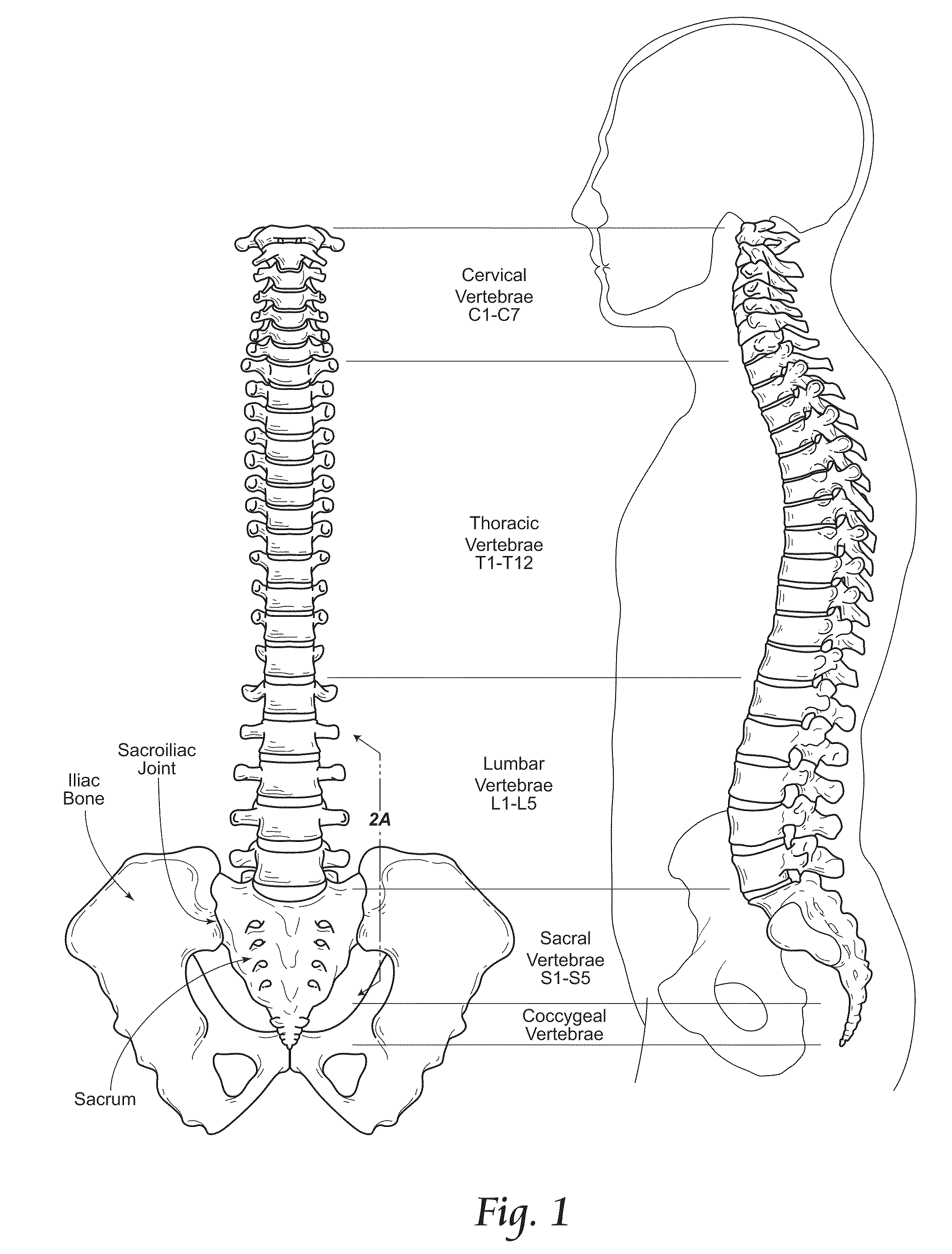 Minimally invasive systems, devices, and surgical methods for performing arthrodesis in the spine