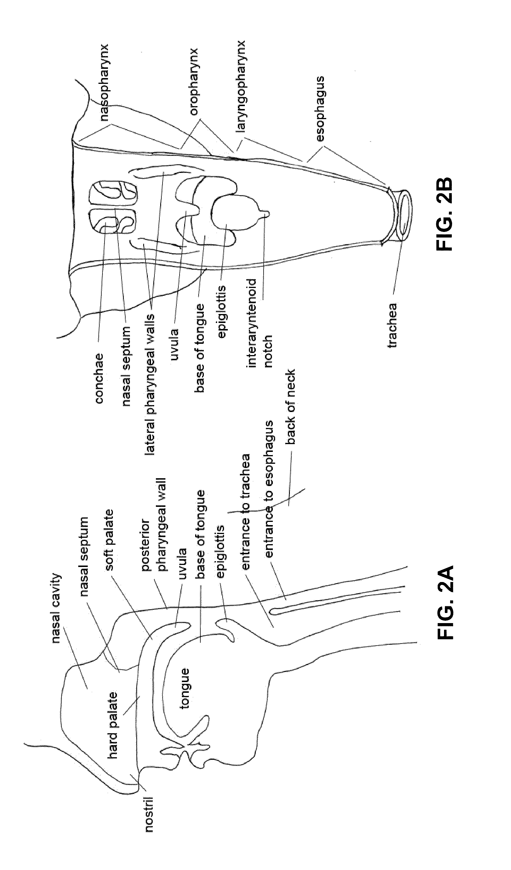 Devices and methods for treating sleep disordered breathing