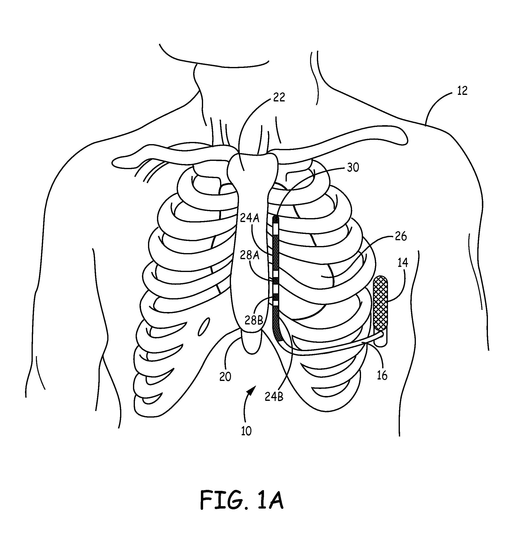 Implantable extravascular electrical stimulation lead having improved sensing and pacing capability
