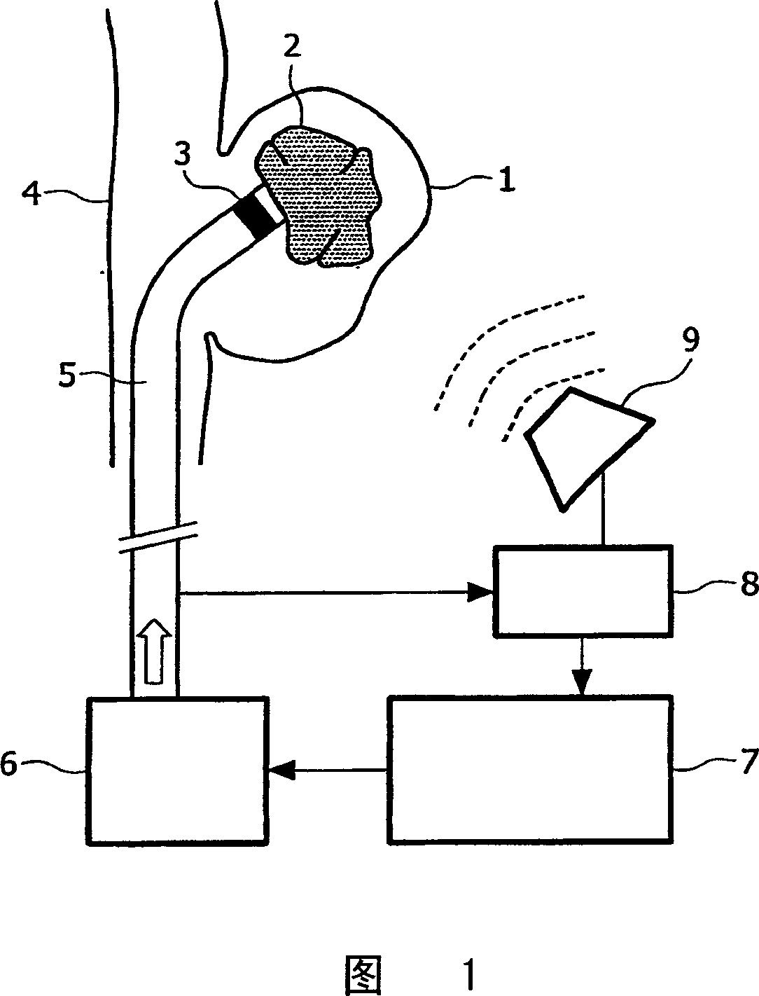 Catheter, apparatus and method for therapeutic embolization