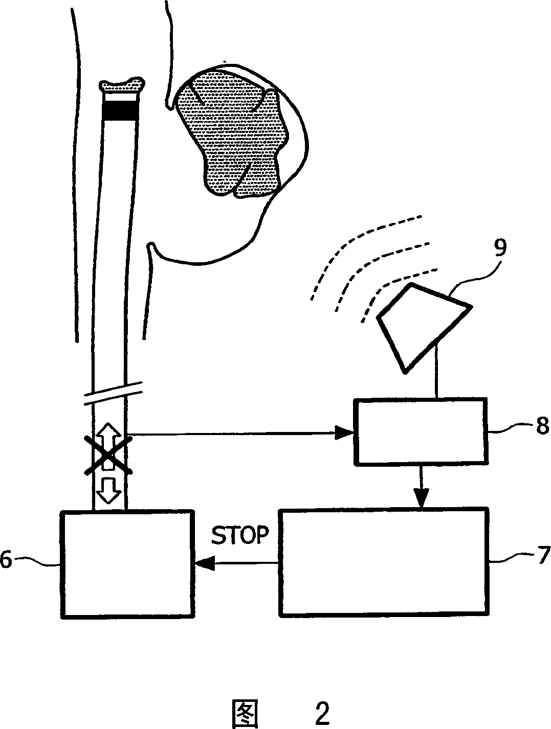 Catheter, apparatus and method for therapeutic embolization
