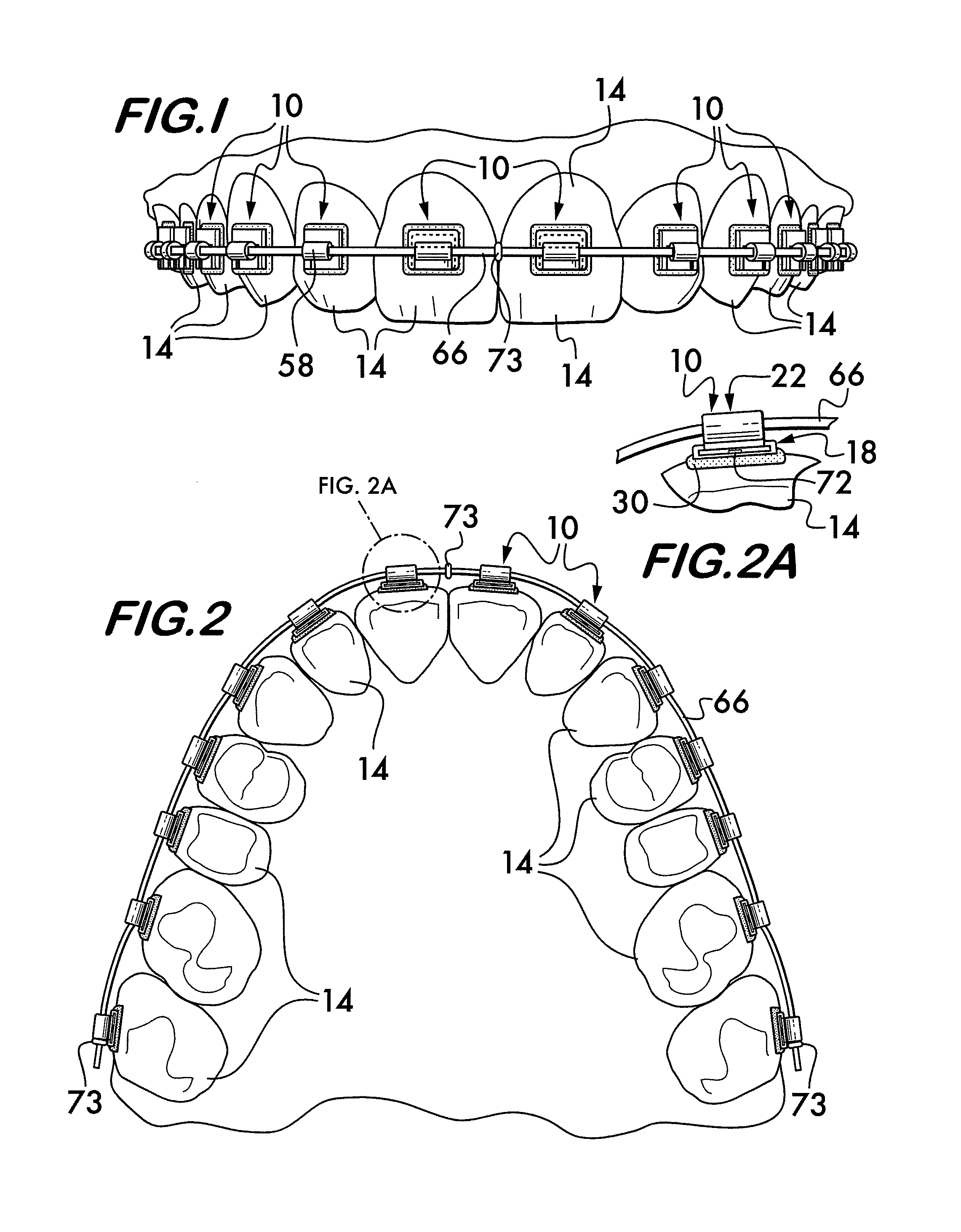 Multi-component orthodontic bracket assembly