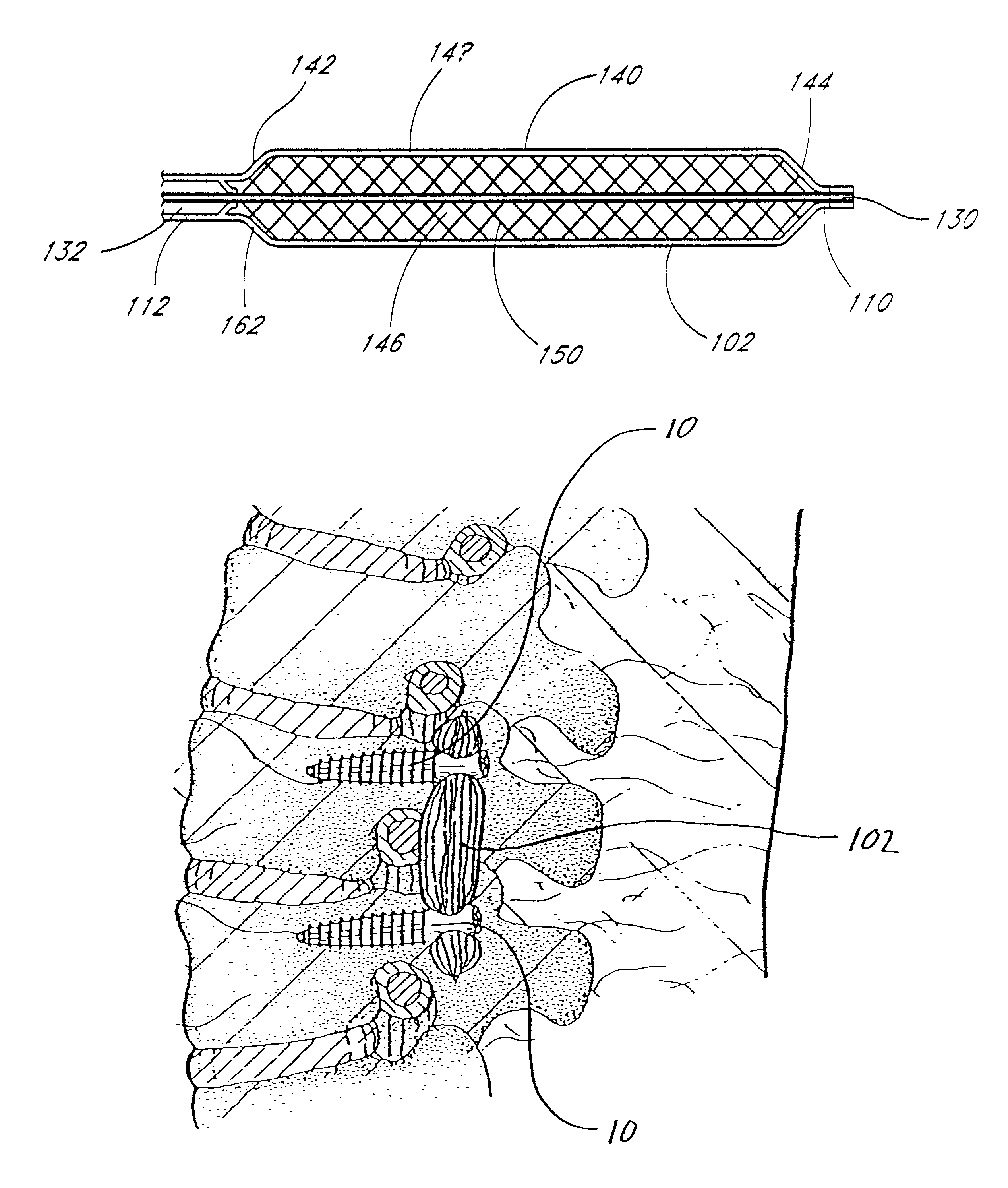 Formable orthopedic fixation system