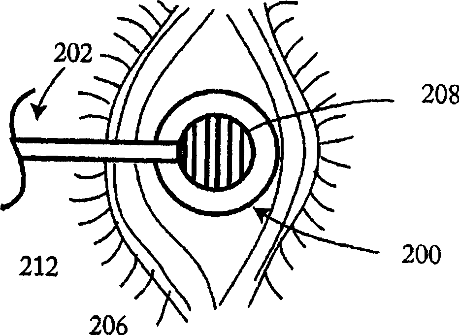 Epithelial pocket expanding tool and combination epithelial delaminating device and corneal reformer