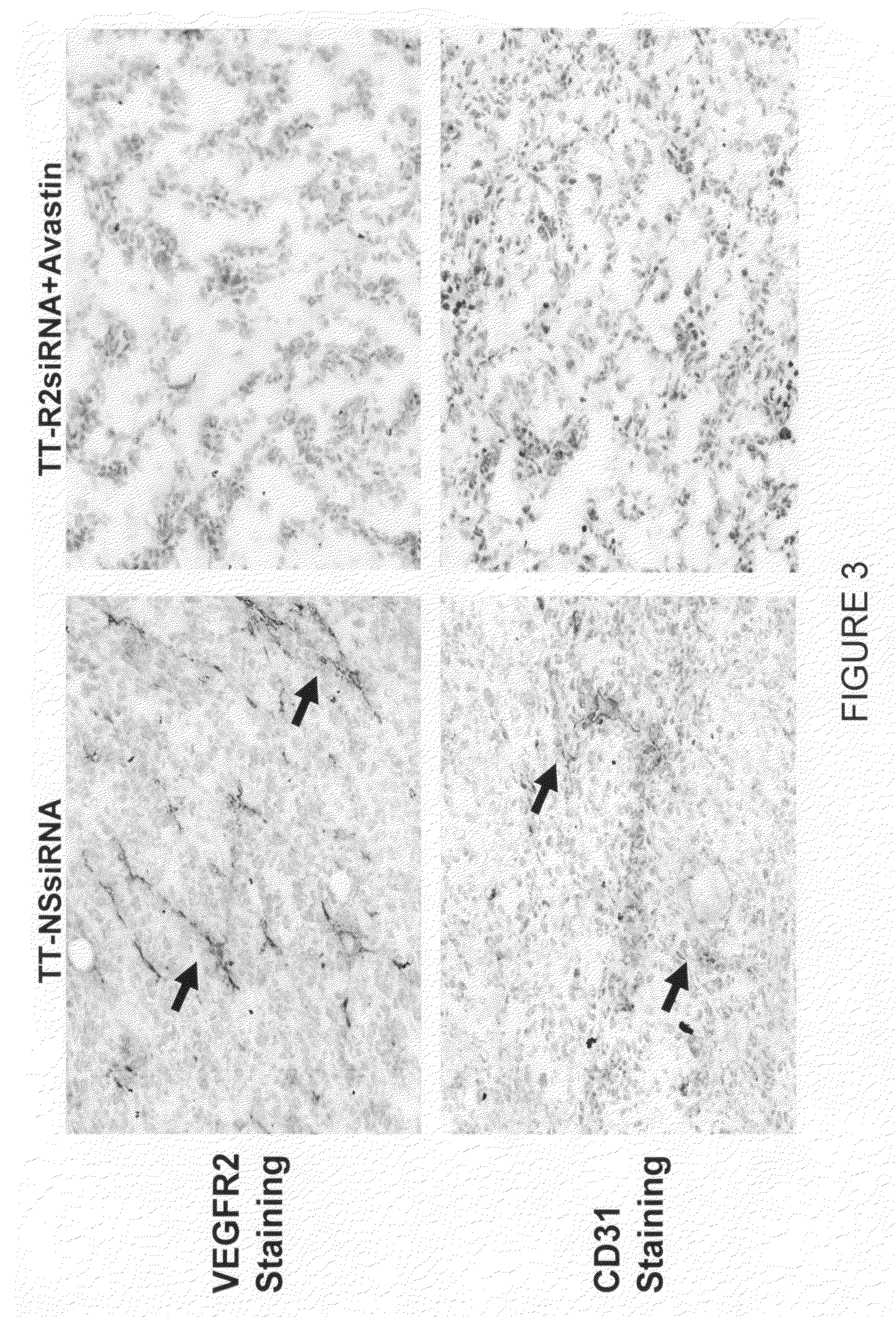 Composition and methods of RNAi therapeutics for treatment of cancer and other neovascularization diseases