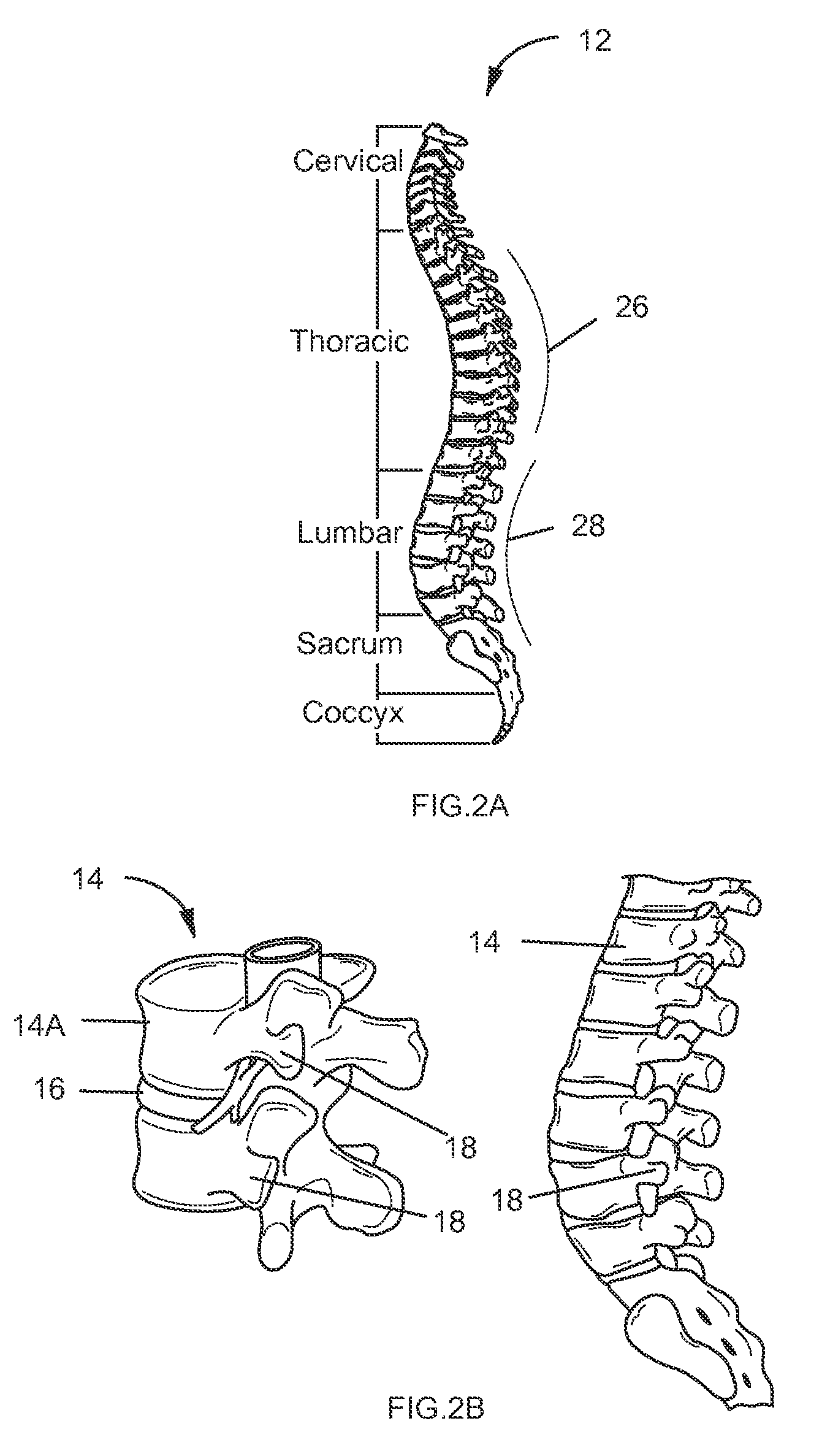 System and methods for correcting spinal deformities